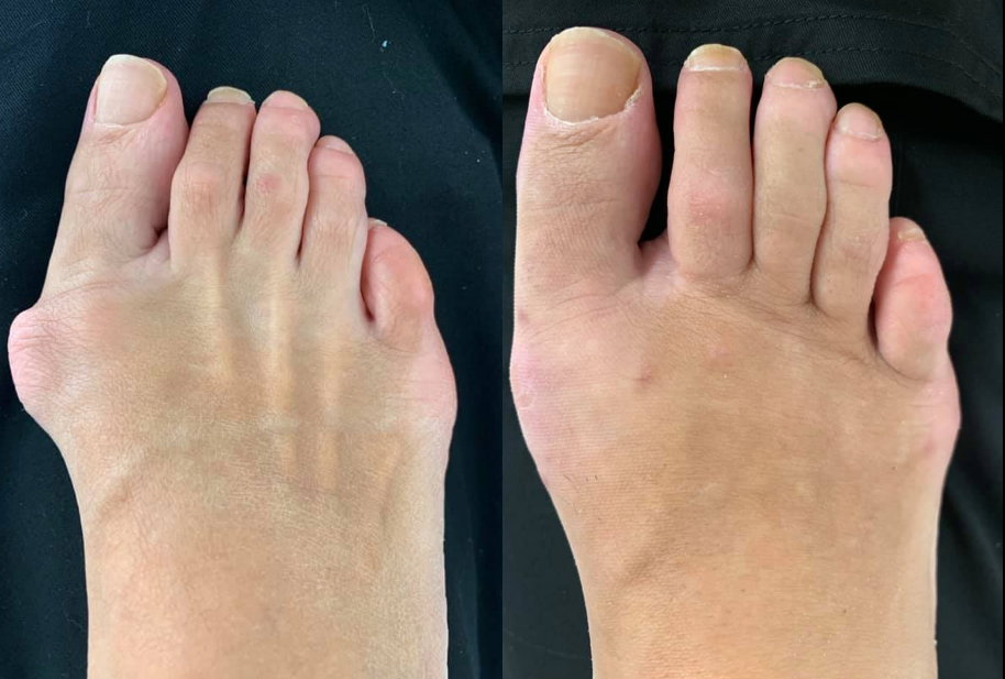 Bunion Surgery Before and After Northwest Surgery Center Wisconsin