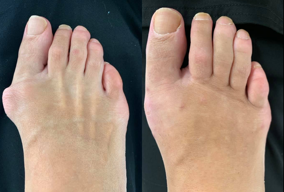 Bunion Surgery Before And After Northwest Surgery Center Wisconsin