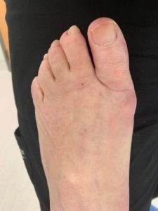 Extreme Bunion after treatment — comparison 26