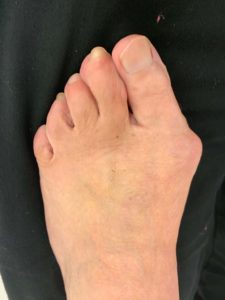 Extreme Bunion before treatment — comparison 26
