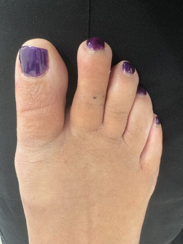 Mallet Toe after treatment — comparison 4
