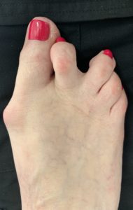 Large Bunion before treatment — comparison 99