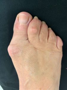Large Bunion before treatment — comparison 97