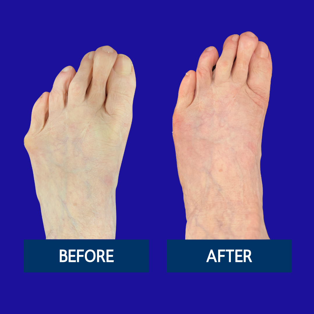 Copy of Hammertoe Before & After (2)
