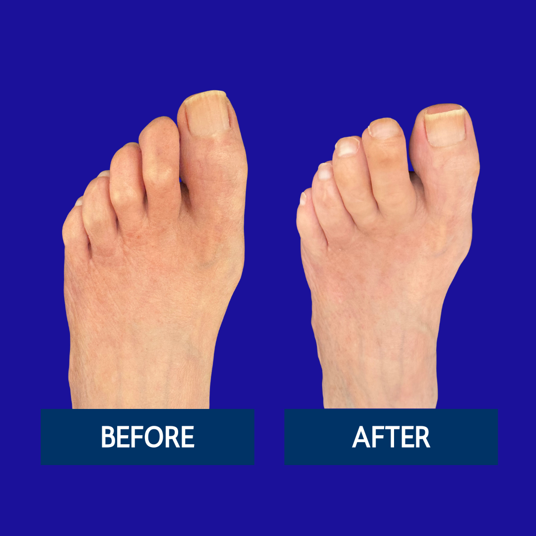 Copy of Hammertoe Before & After (3)