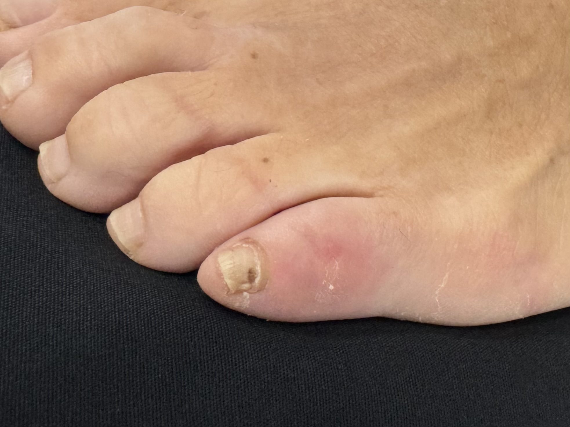 After Surgery