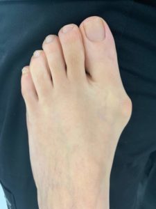 Large Bunion before treatment — comparison 95