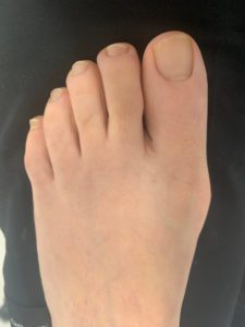 Large Bunion after treatment — comparison 95