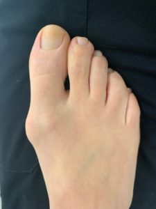 Hallux valgus (Bunion) Surgery on Right Foot (1)