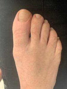 Hallux valgus (Bunion) Surgery on Right Foot Results (1)