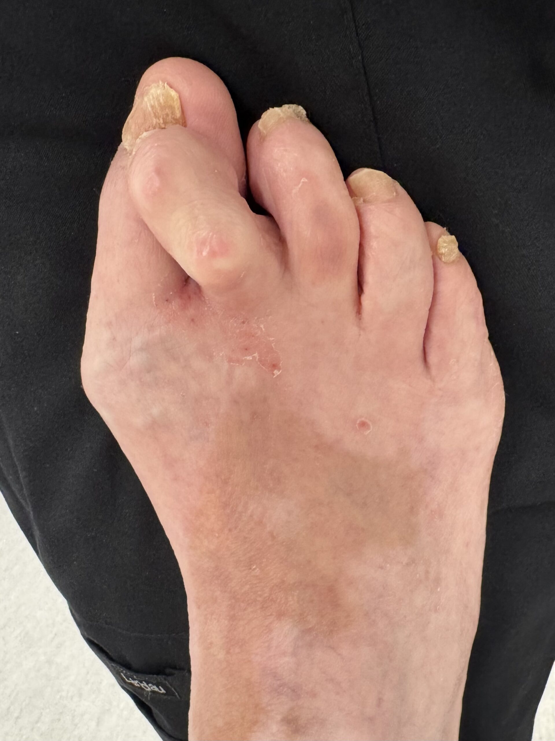 Extreme Bunion before treatment — comparison 4