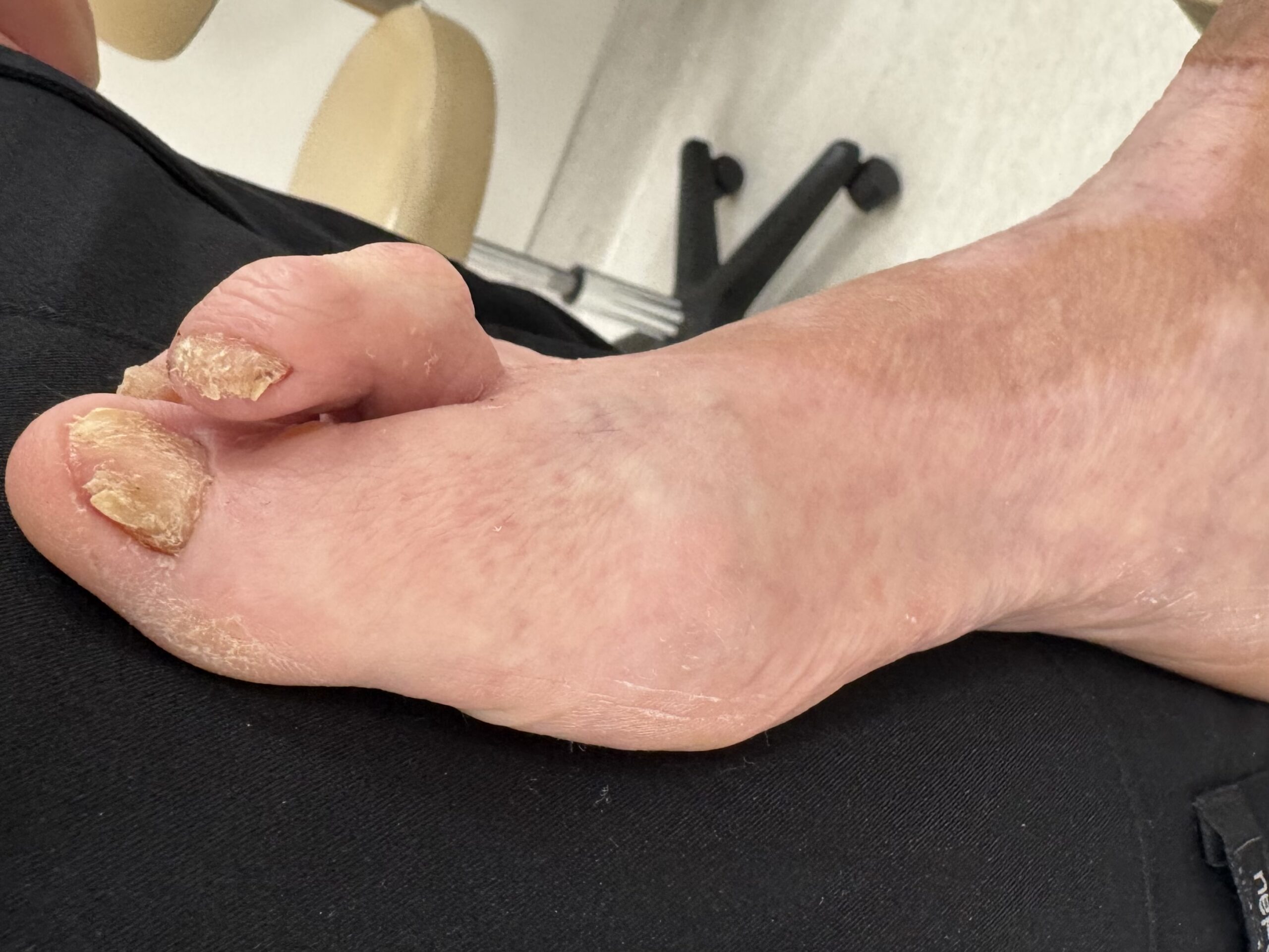 Extreme Bunion before treatment — comparison 5