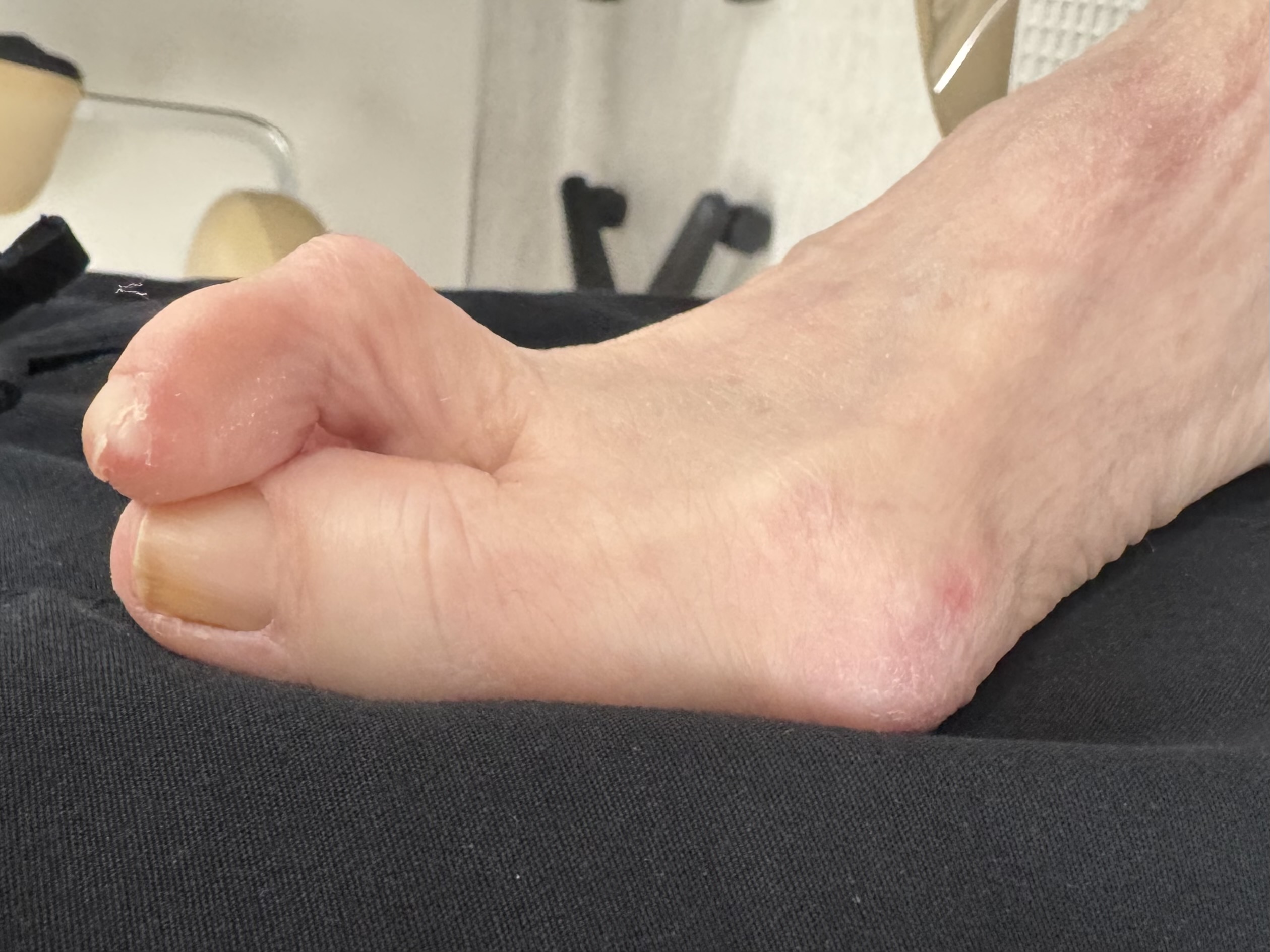 Extreme Bunion before treatment — comparison 16