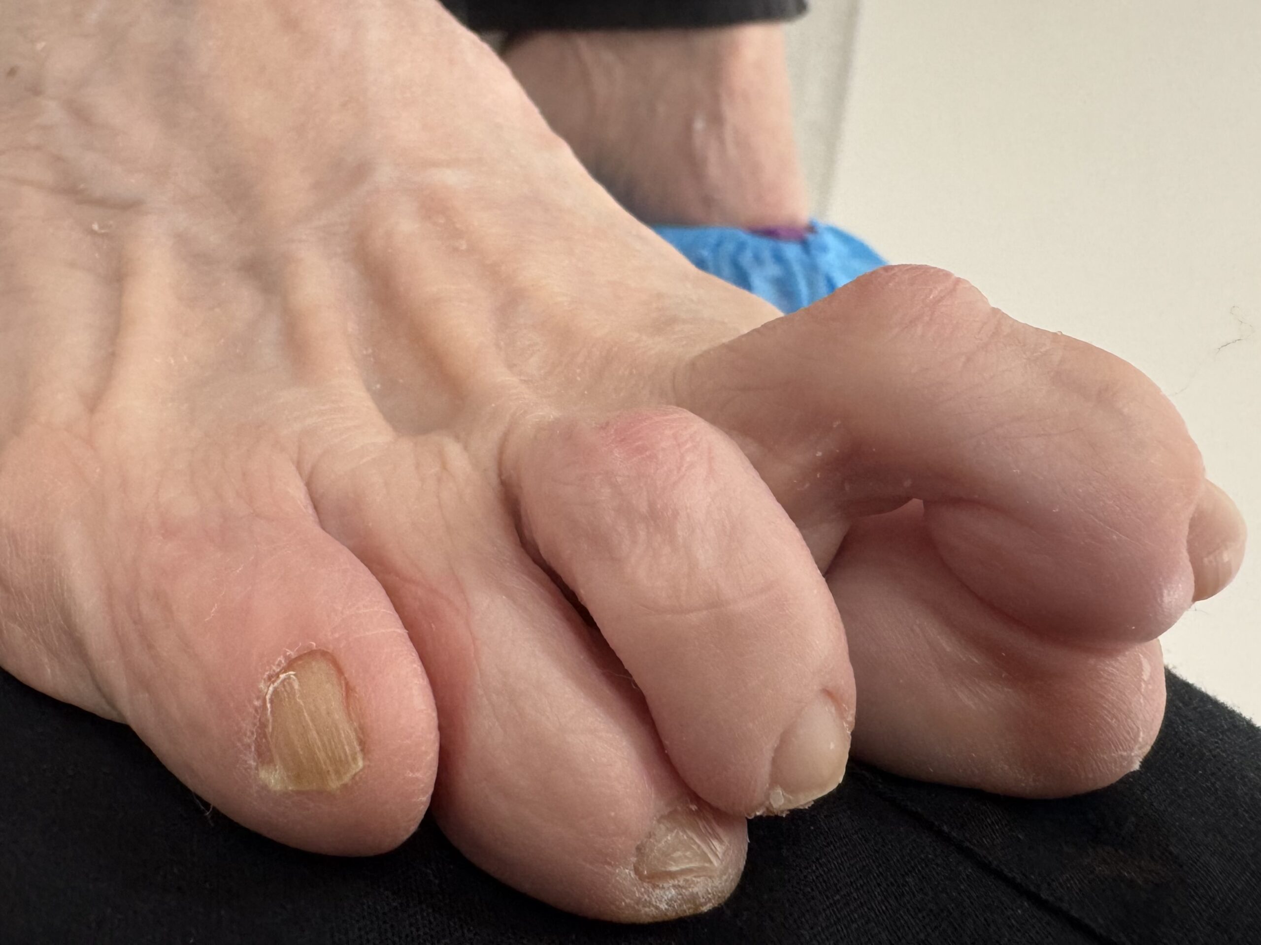 Extreme Bunion before treatment — comparison 17