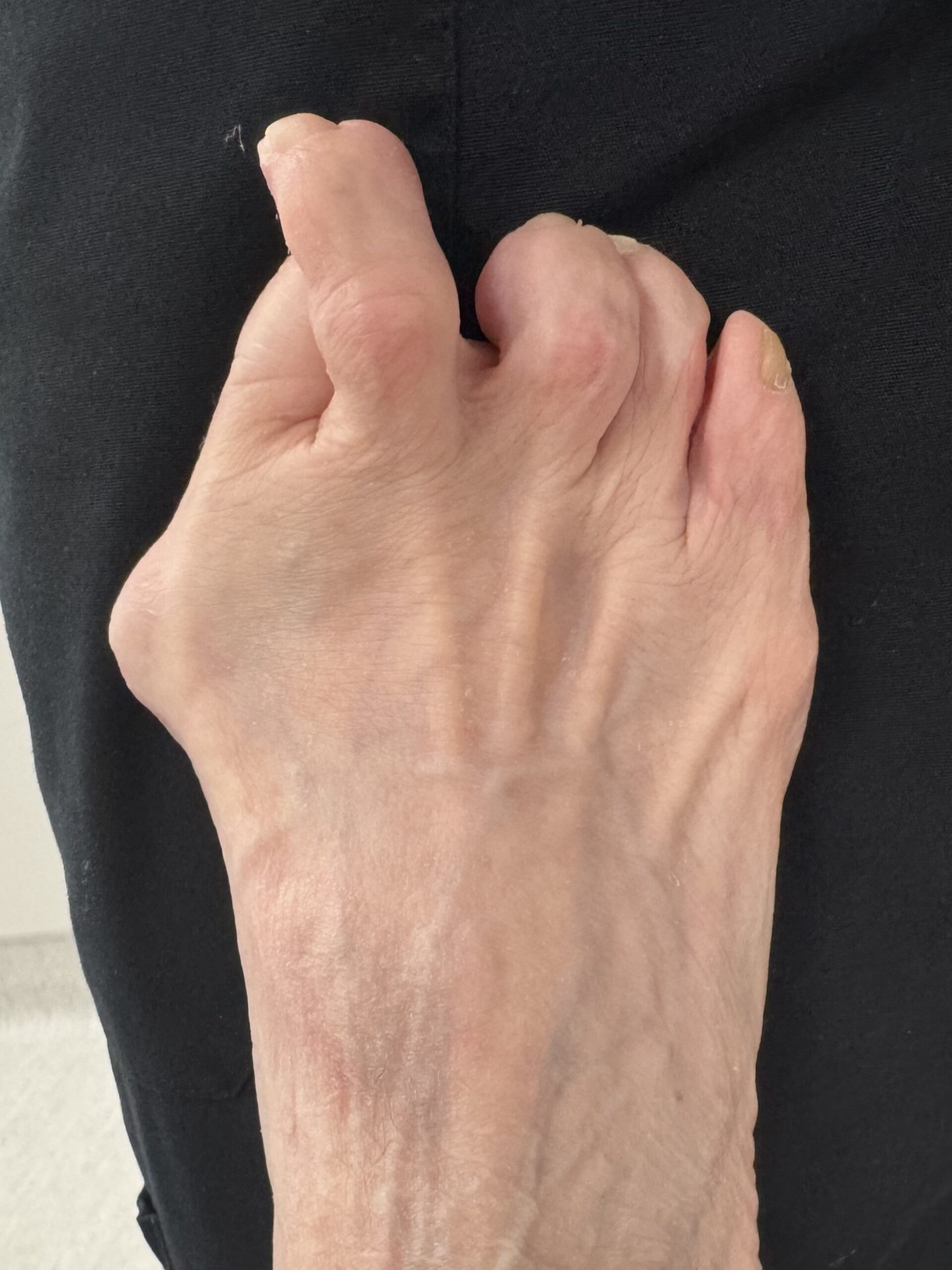 Extreme Bunion before treatment — comparison 11