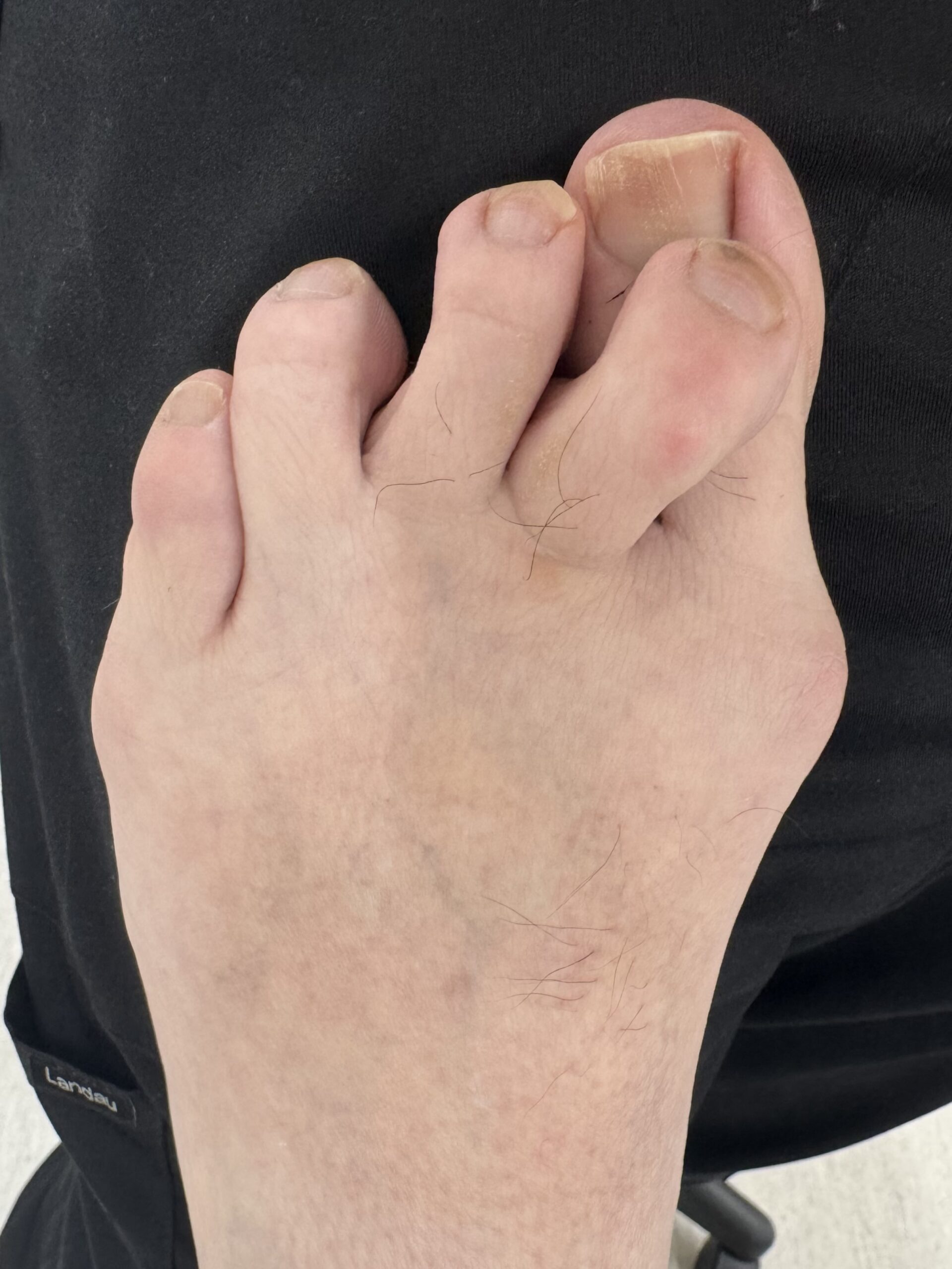 Extreme Bunion before treatment — comparison 1