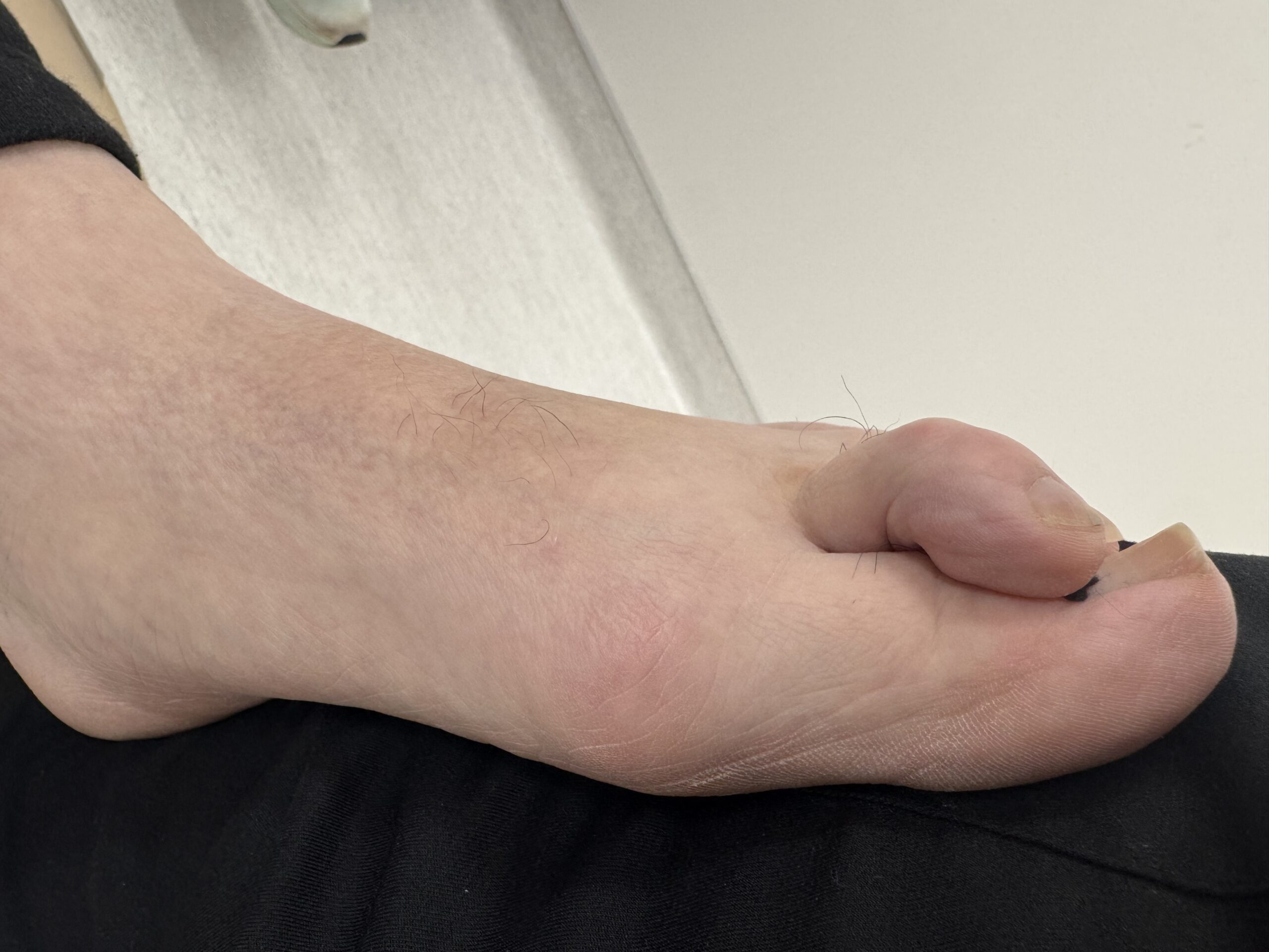 Extreme Bunion before treatment — comparison 2