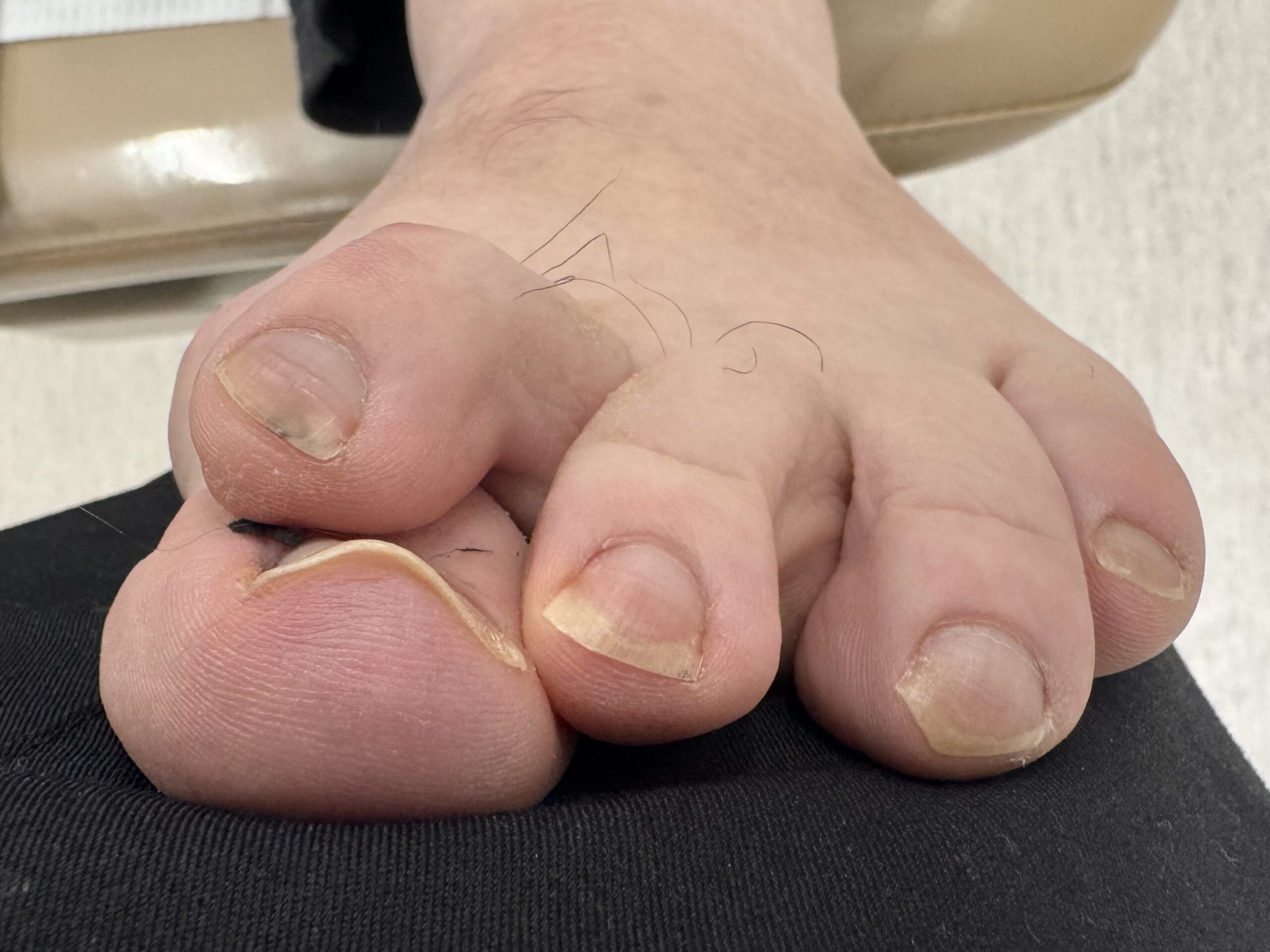 Extreme Bunion before treatment — comparison 3