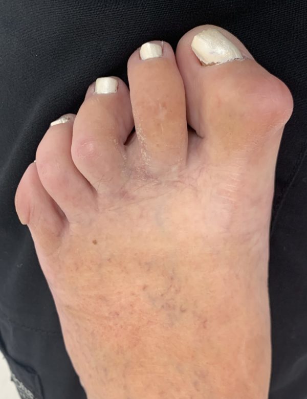 Mallet Toe before treatment — comparison 5