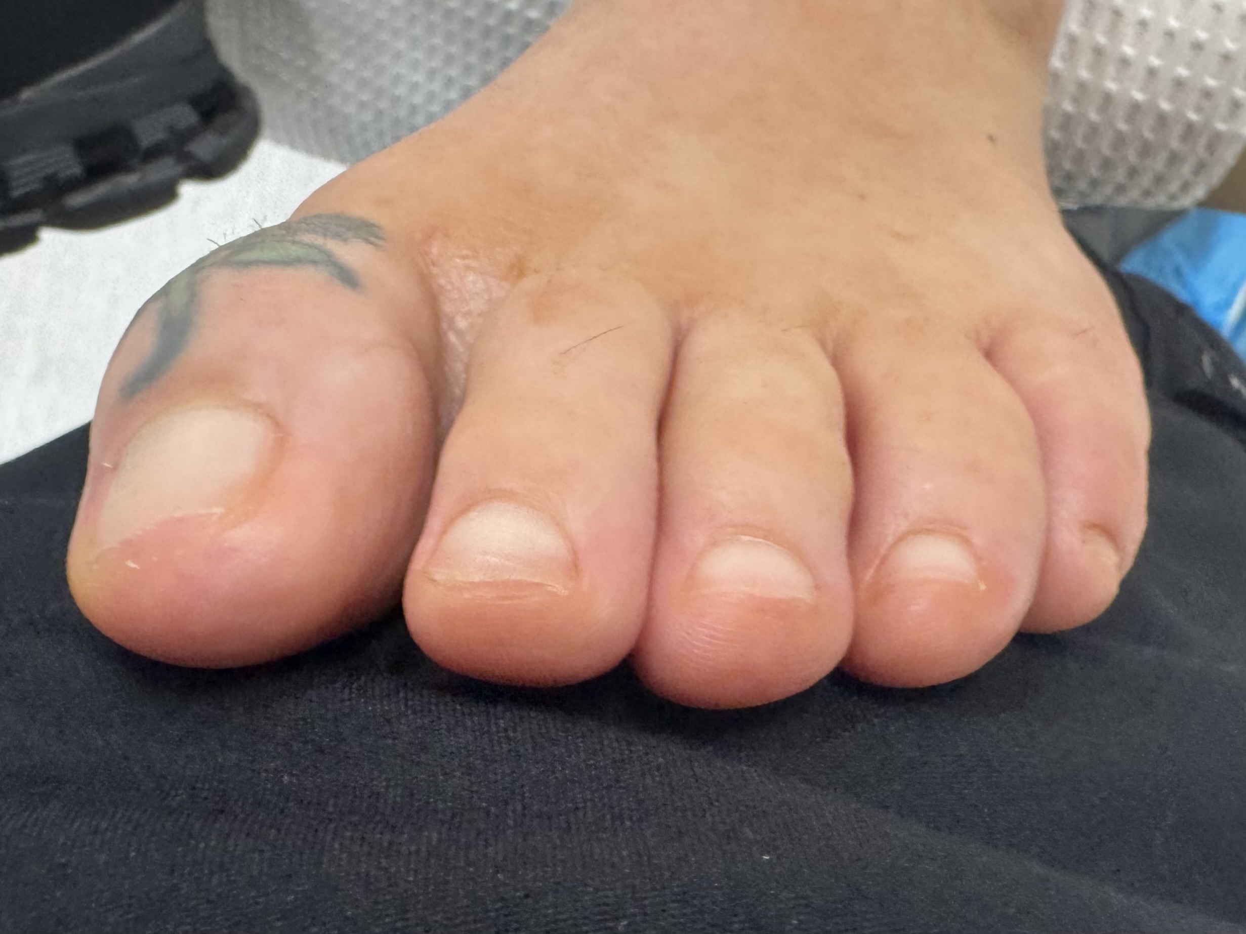 Mallet Toe after treatment — comparison 1