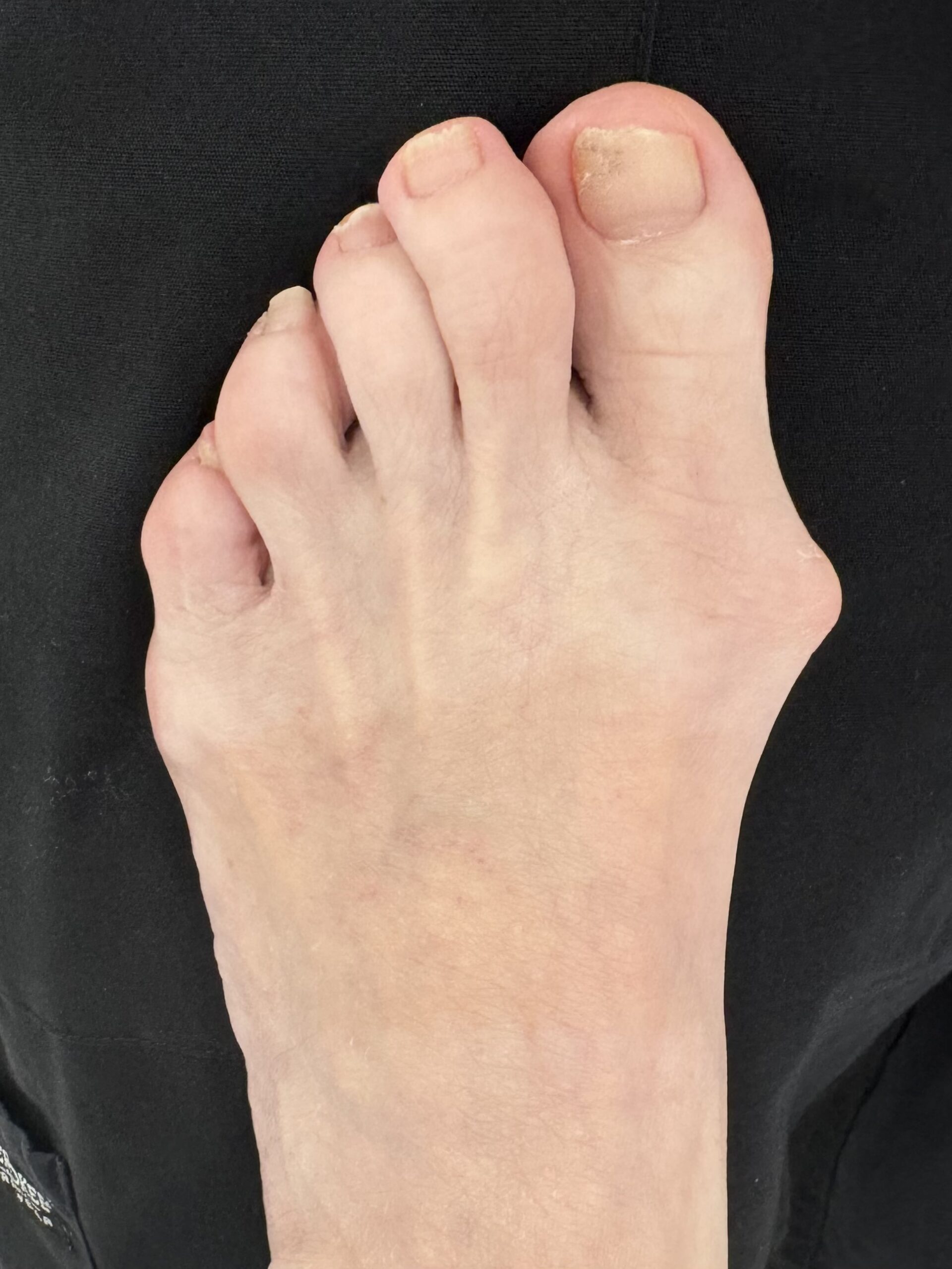 Before Surgery
