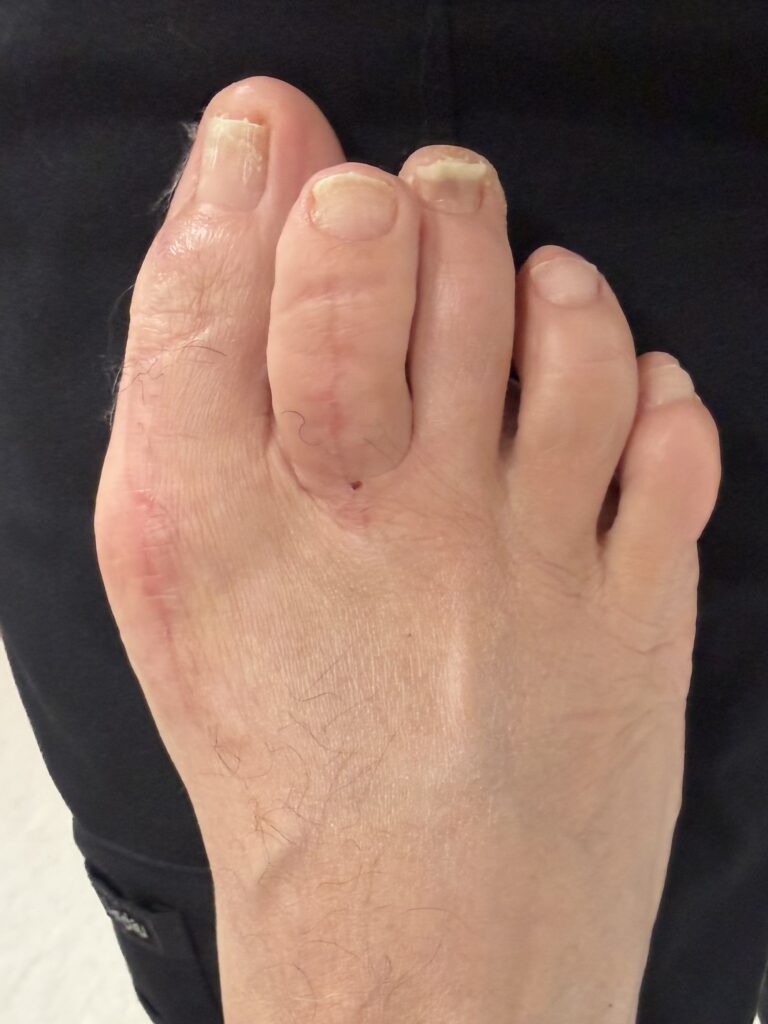 having problems after bunion surgery