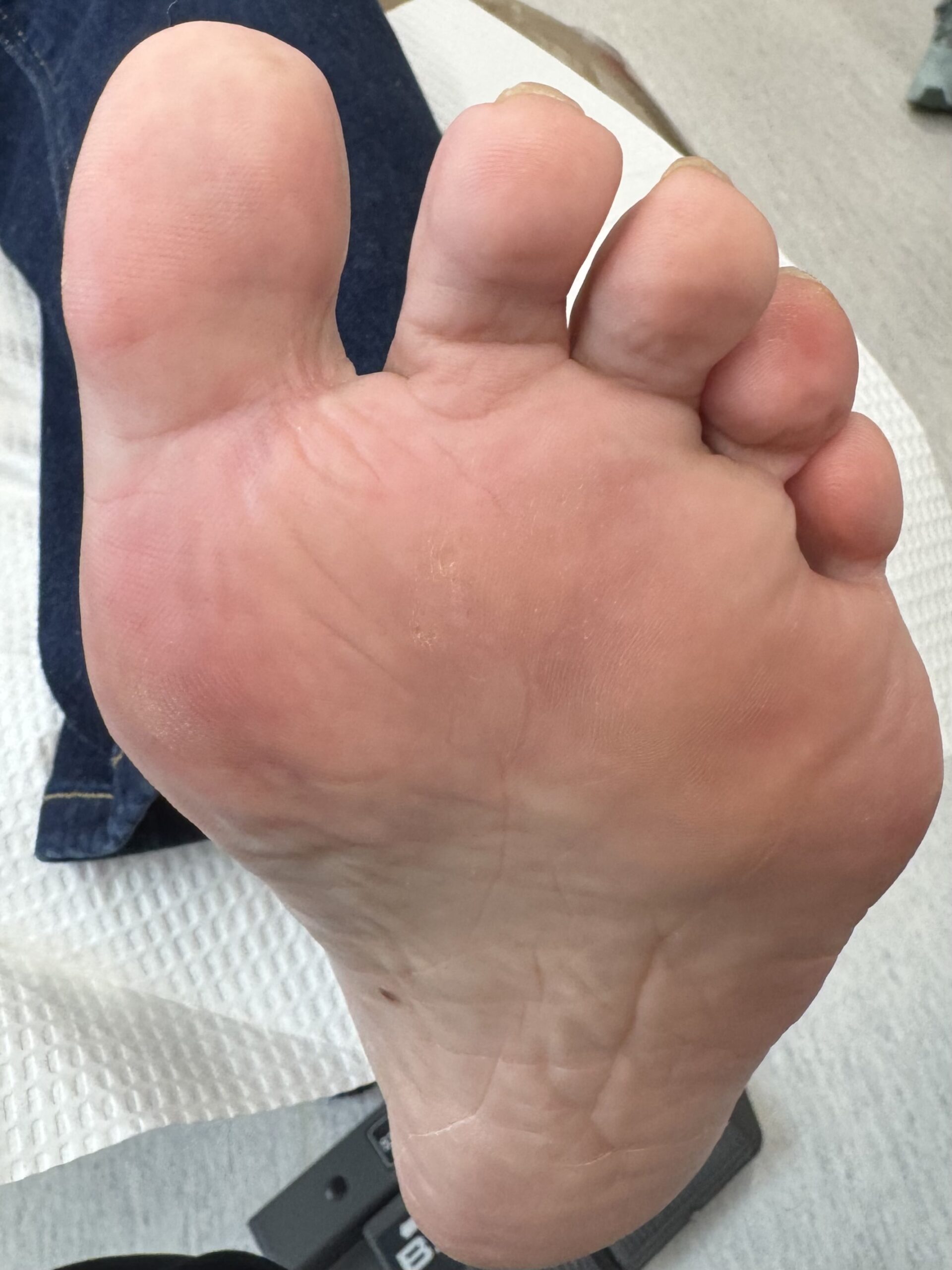After Surgery
