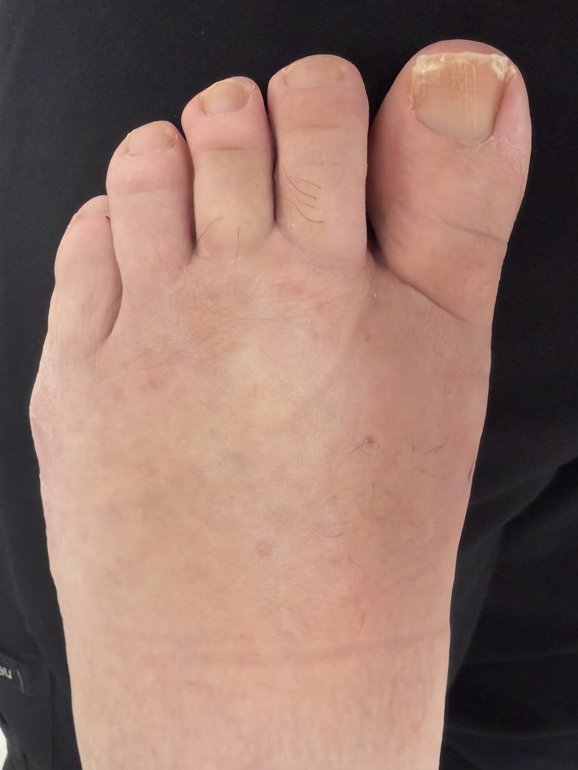 Extreme Bunion after treatment — comparison 1