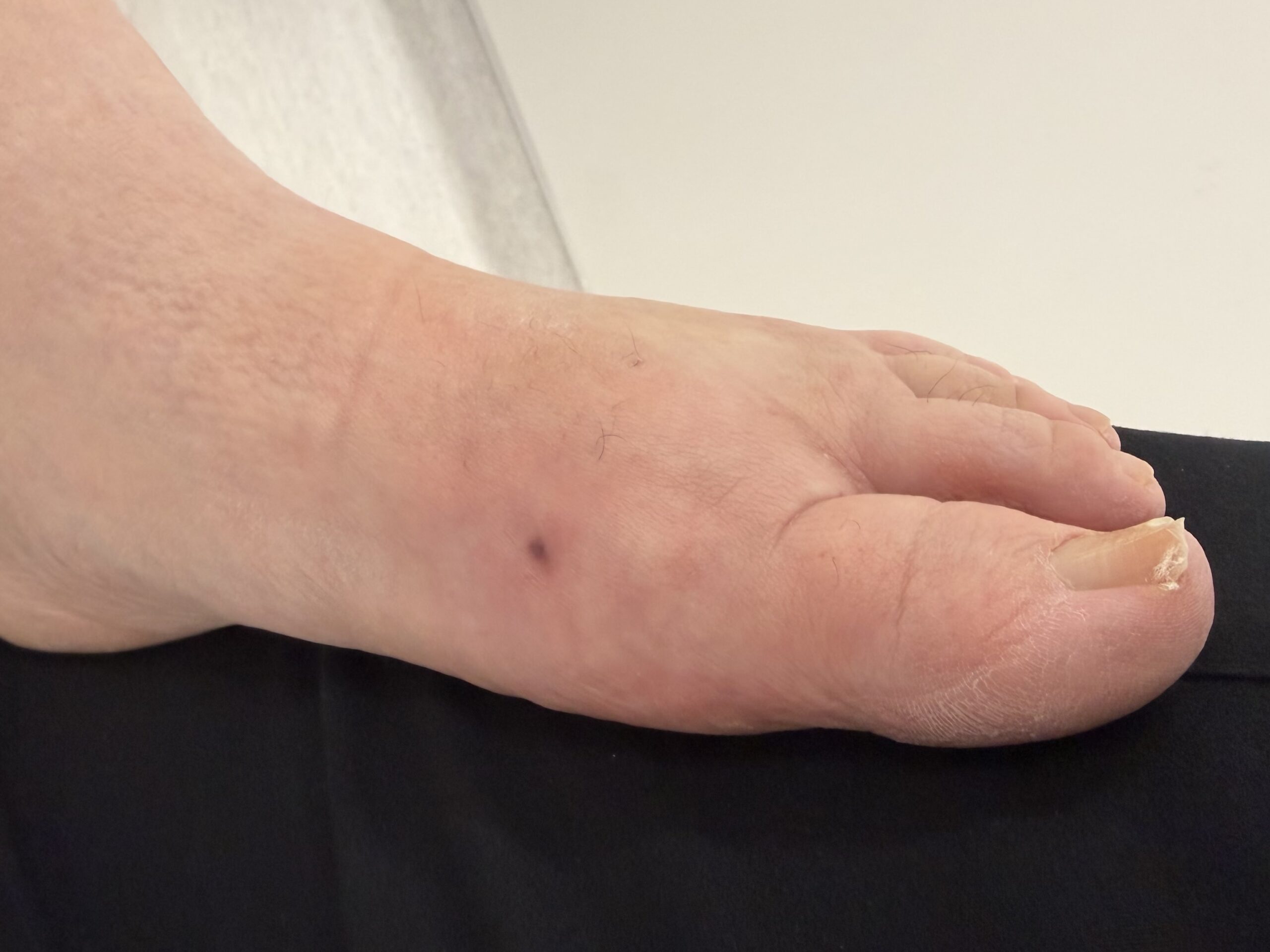 Extreme Bunion after treatment — comparison 2
