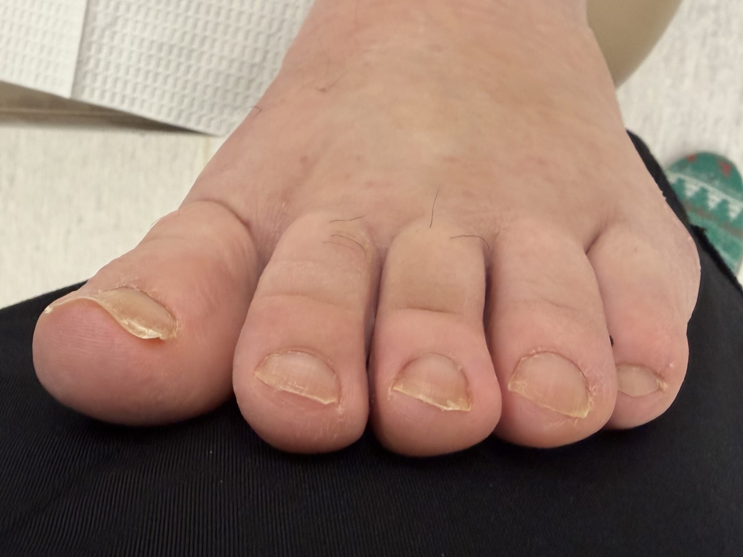Extreme Bunion after treatment — comparison 3