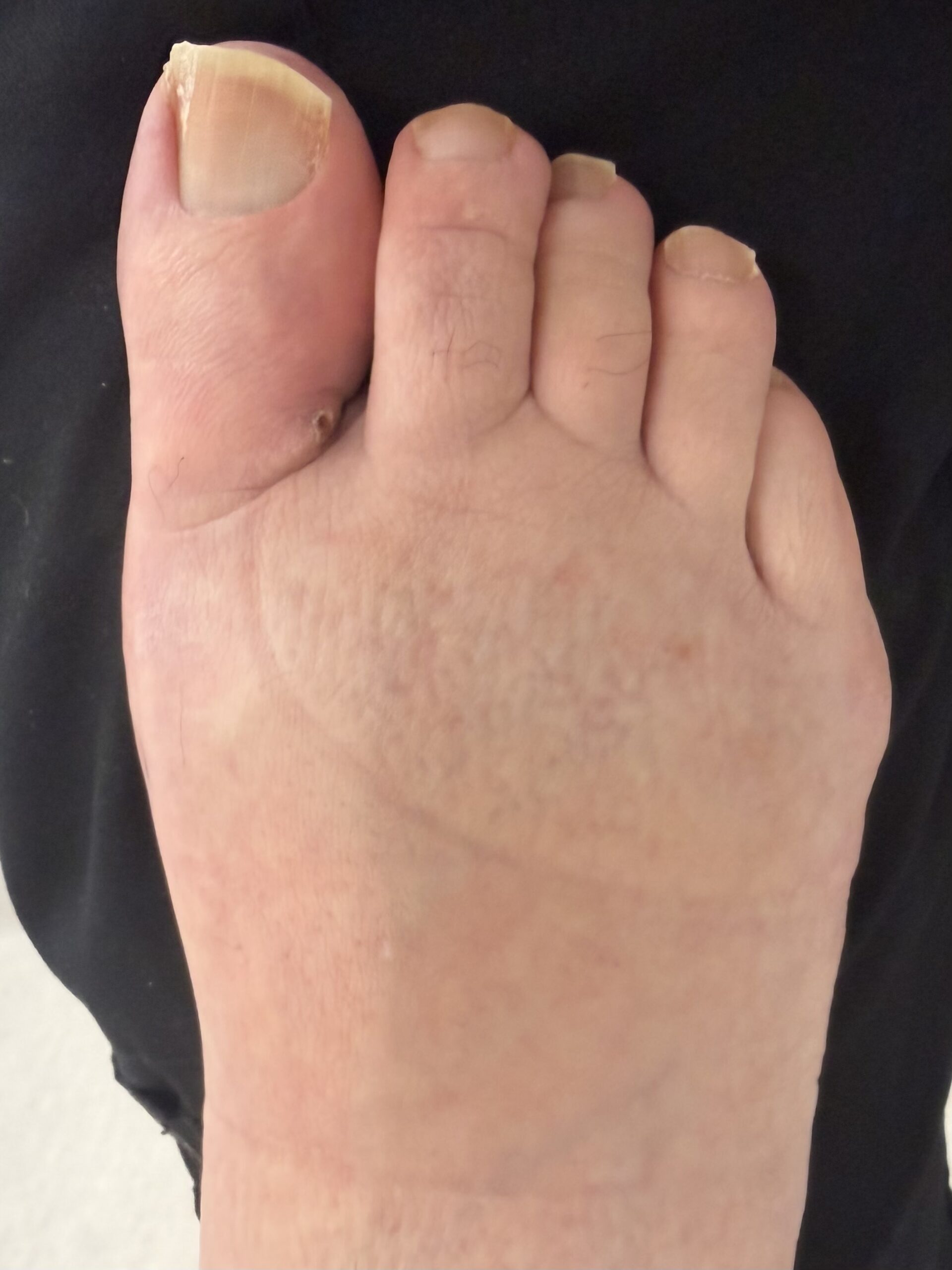 Extreme Bunion after treatment — comparison 8