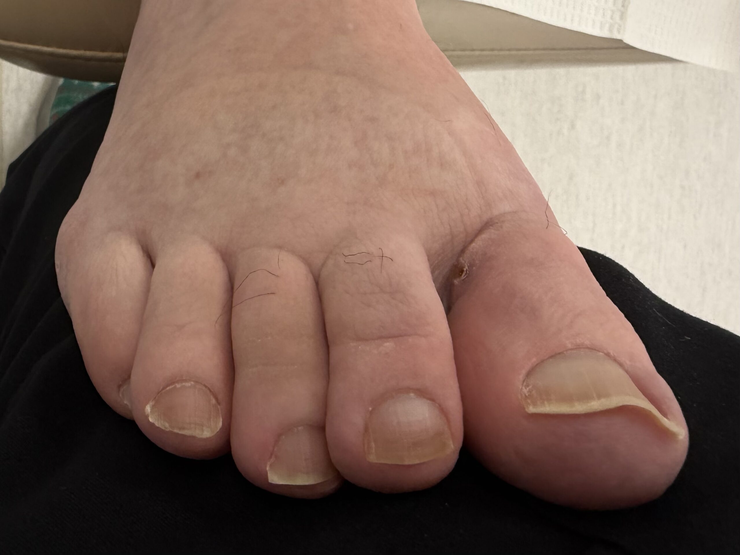 Extreme Bunion after treatment — comparison 10