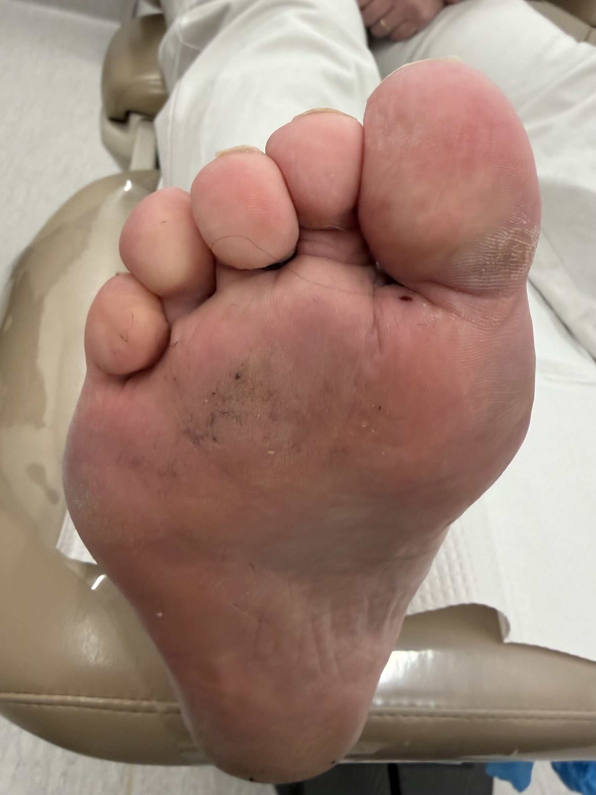 Extreme Bunion after treatment — comparison 9