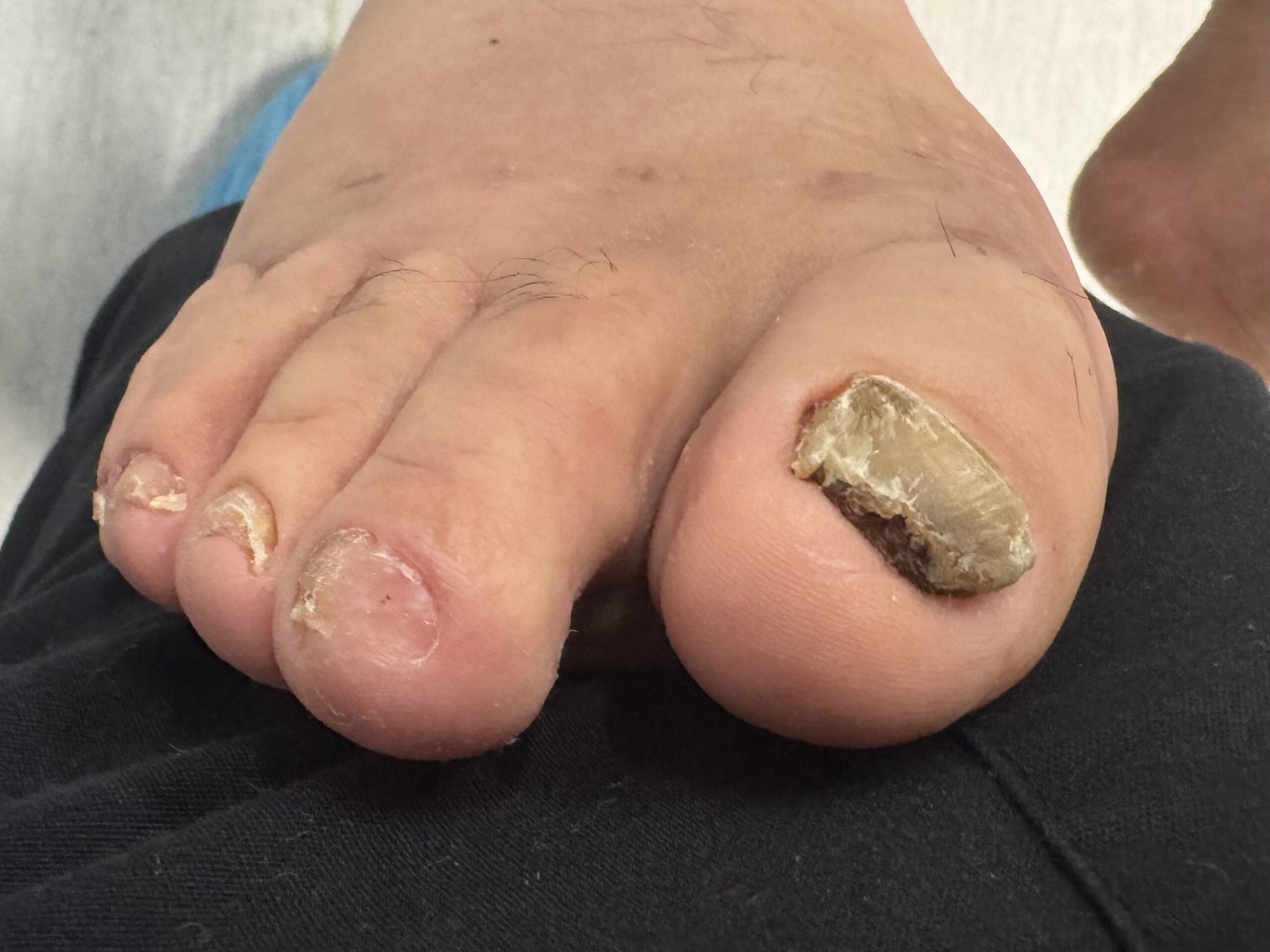 Extreme Bunion after treatment — comparison 37
