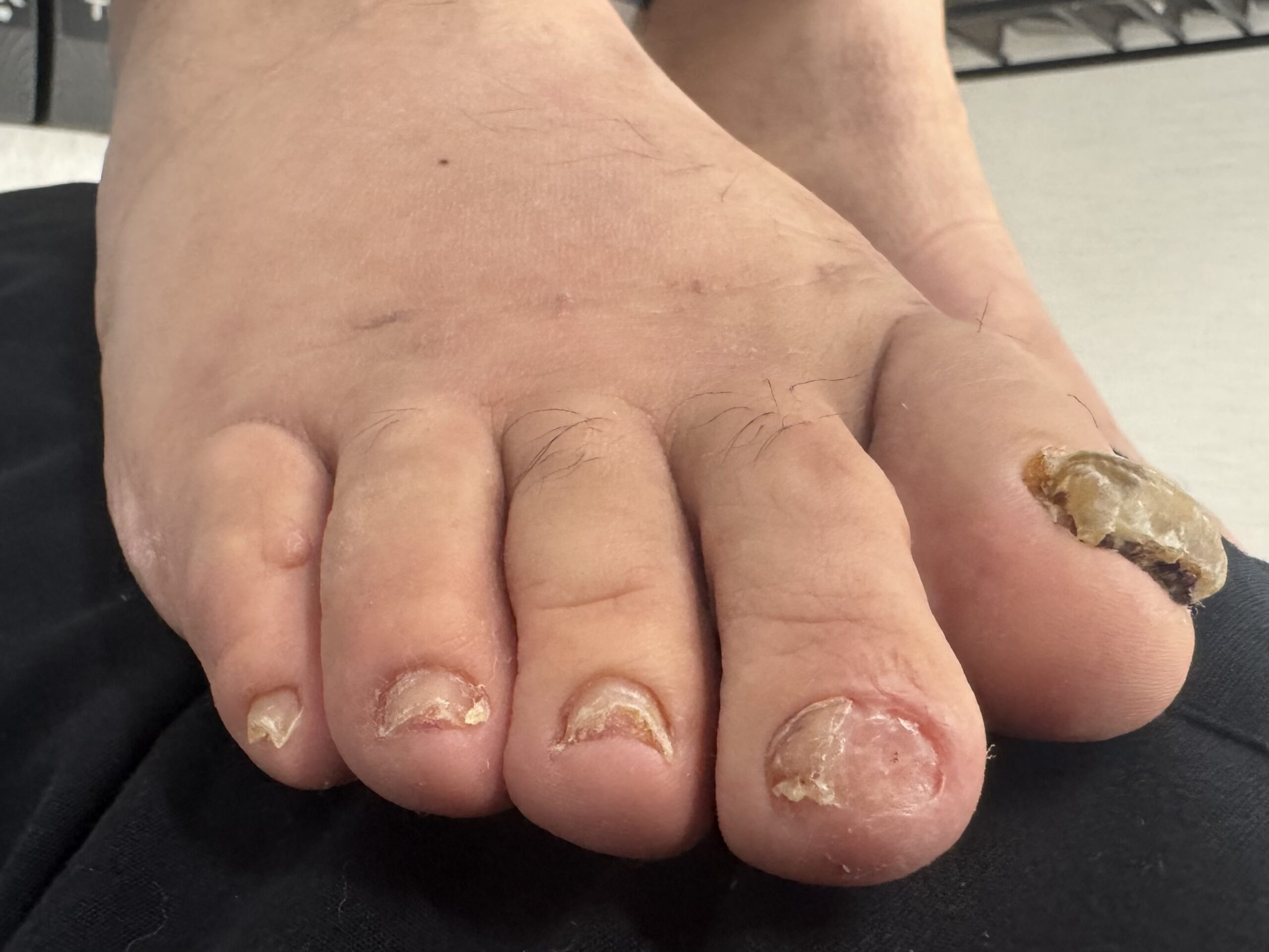 Extreme Bunion after treatment — comparison 41