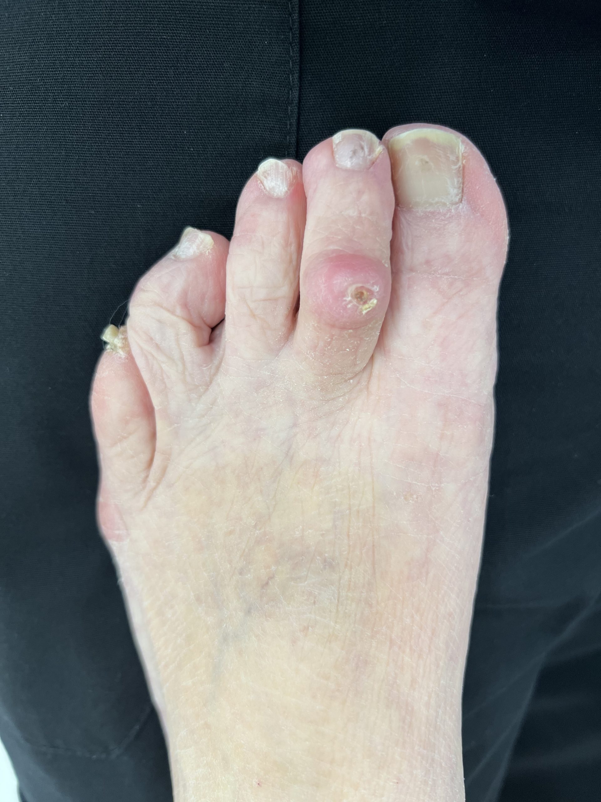 Diagnosis - hammertoes