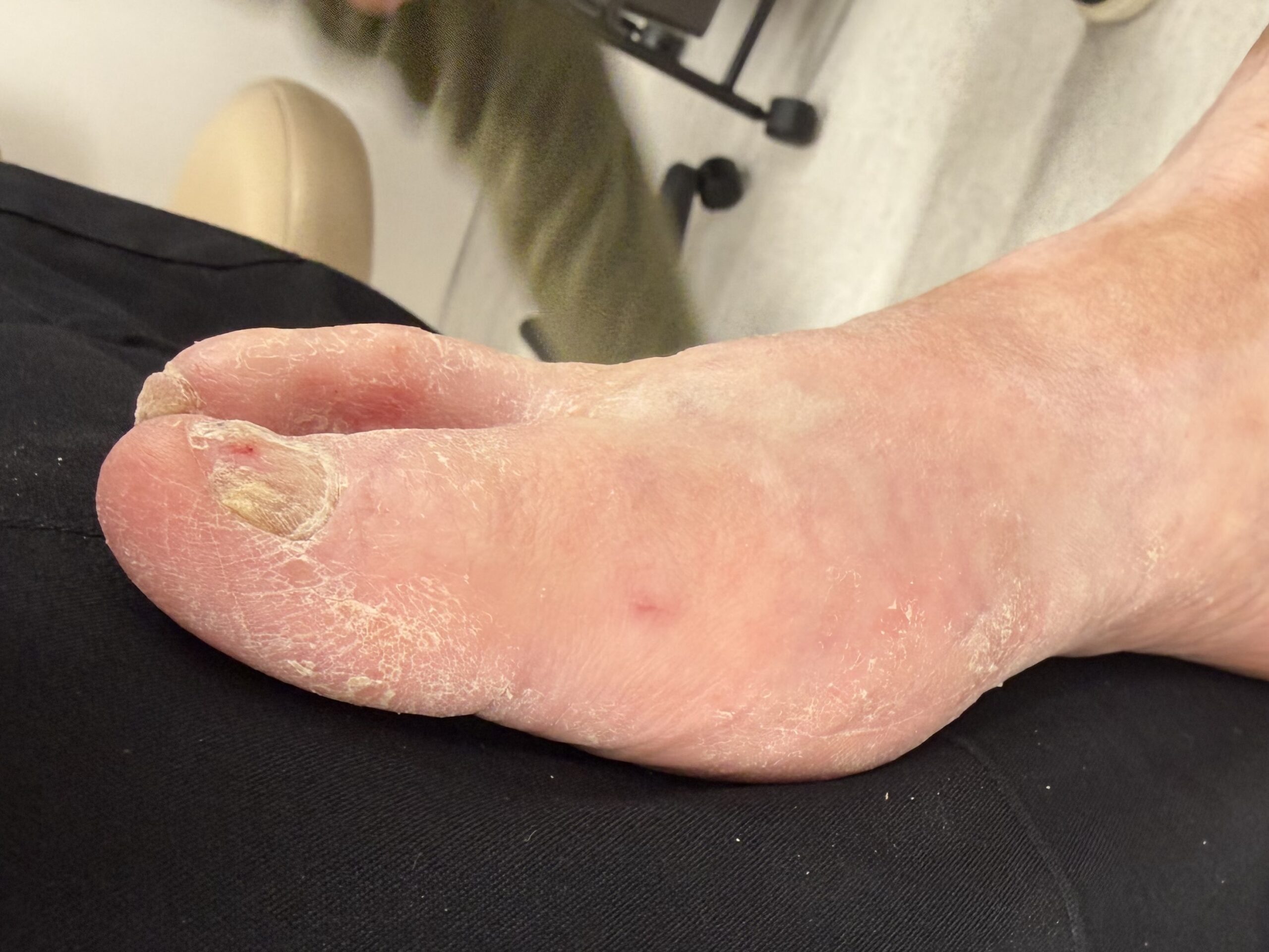 Extreme Bunion after treatment — comparison 5