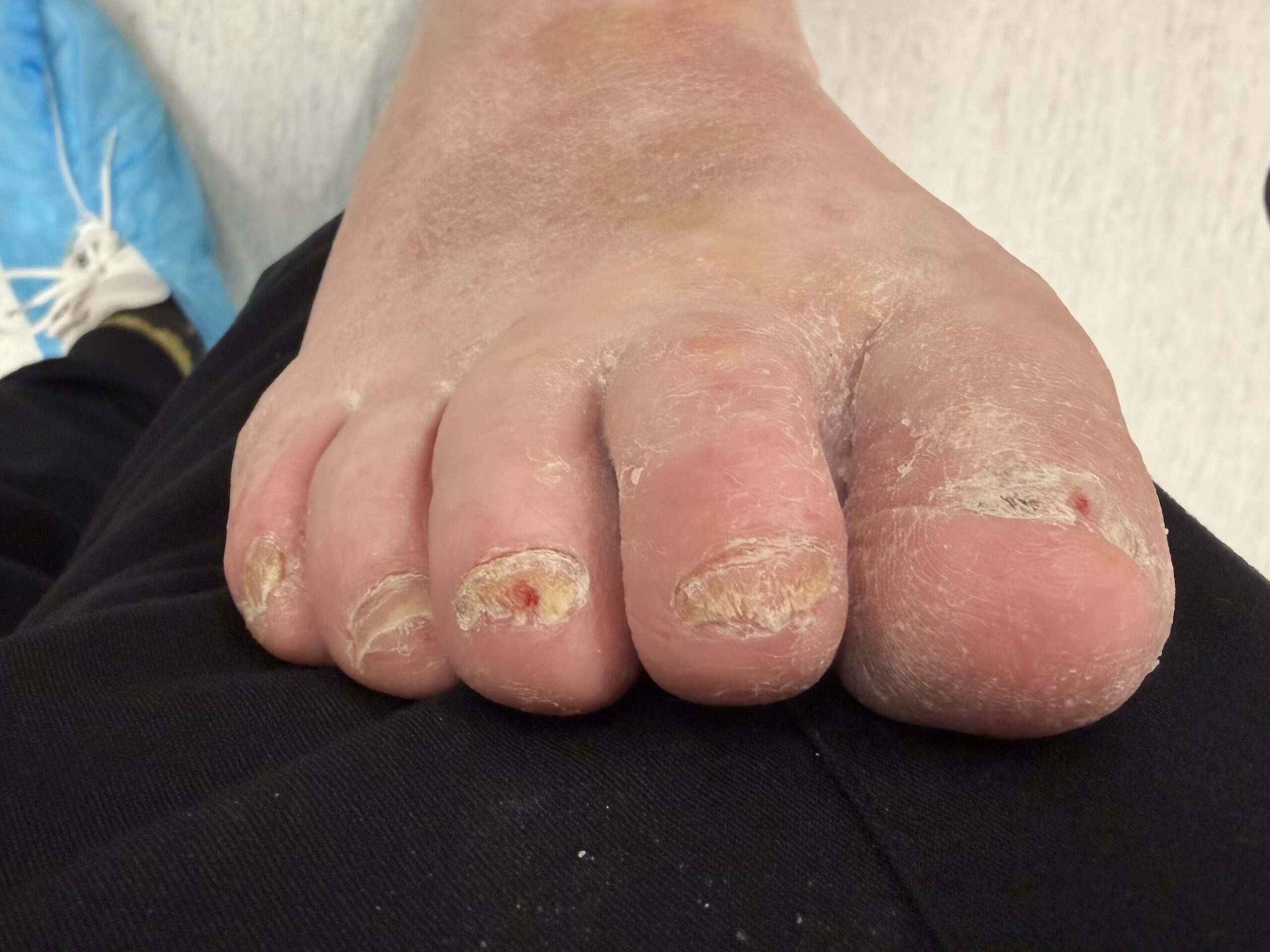 Extreme Bunion after treatment — comparison 6