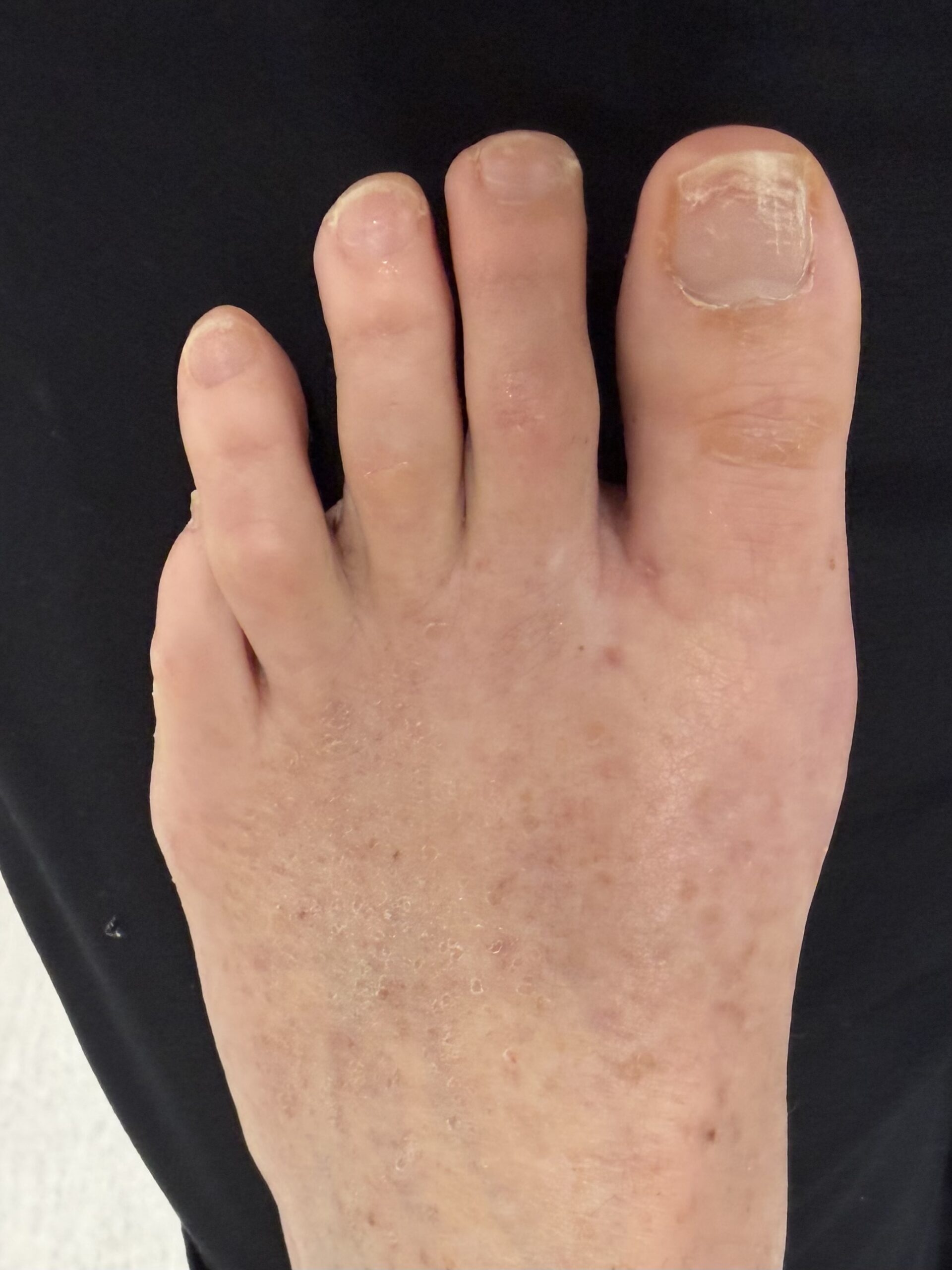 How Painful Is Bunion Surgery?