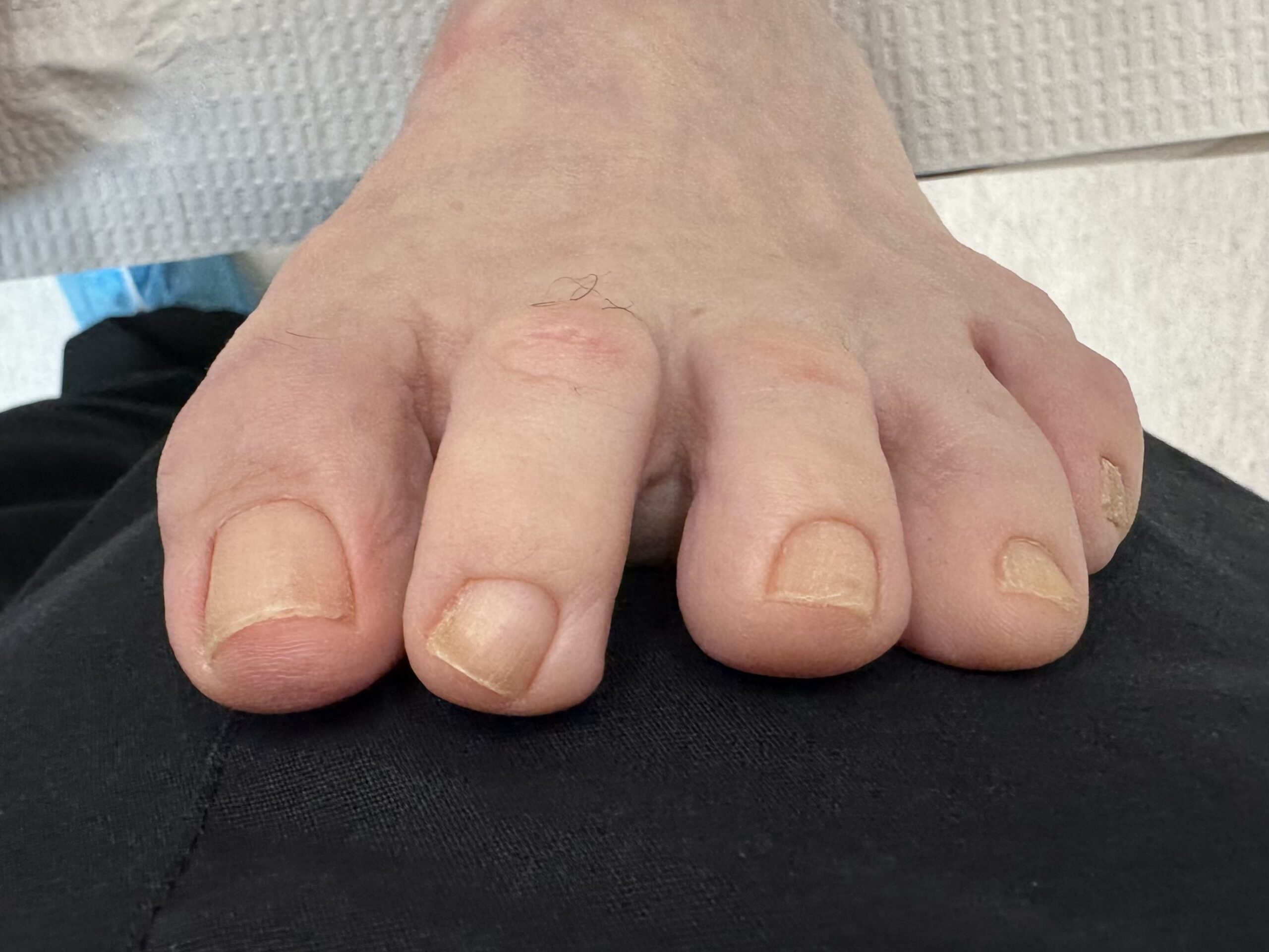 Extreme Bunion after treatment — comparison 19
