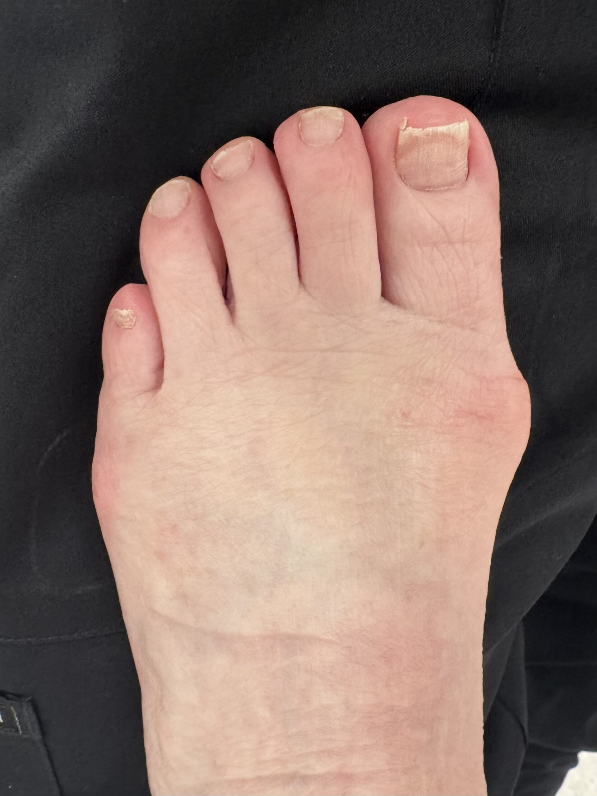 After Surgery
