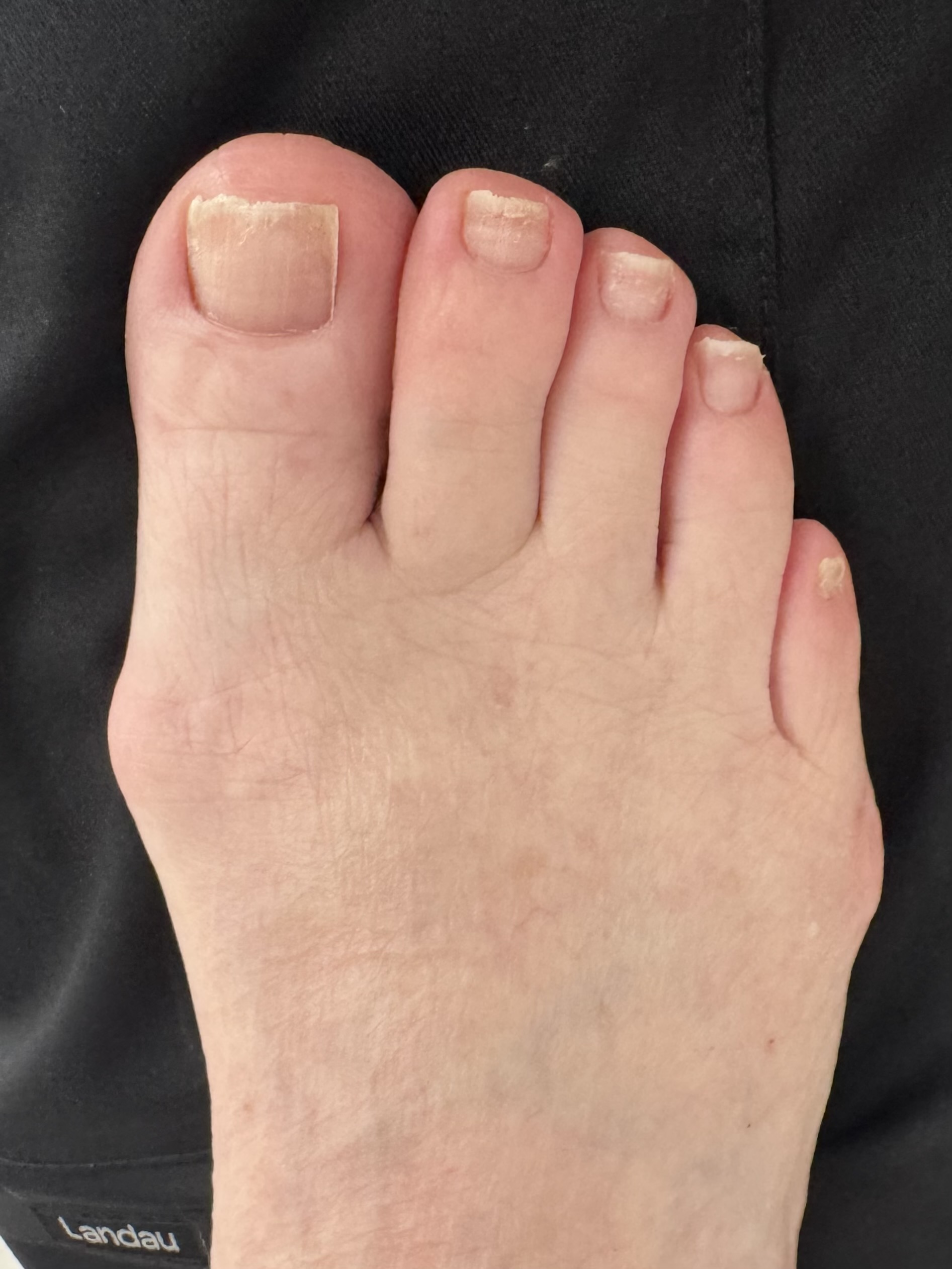 Before Surgery