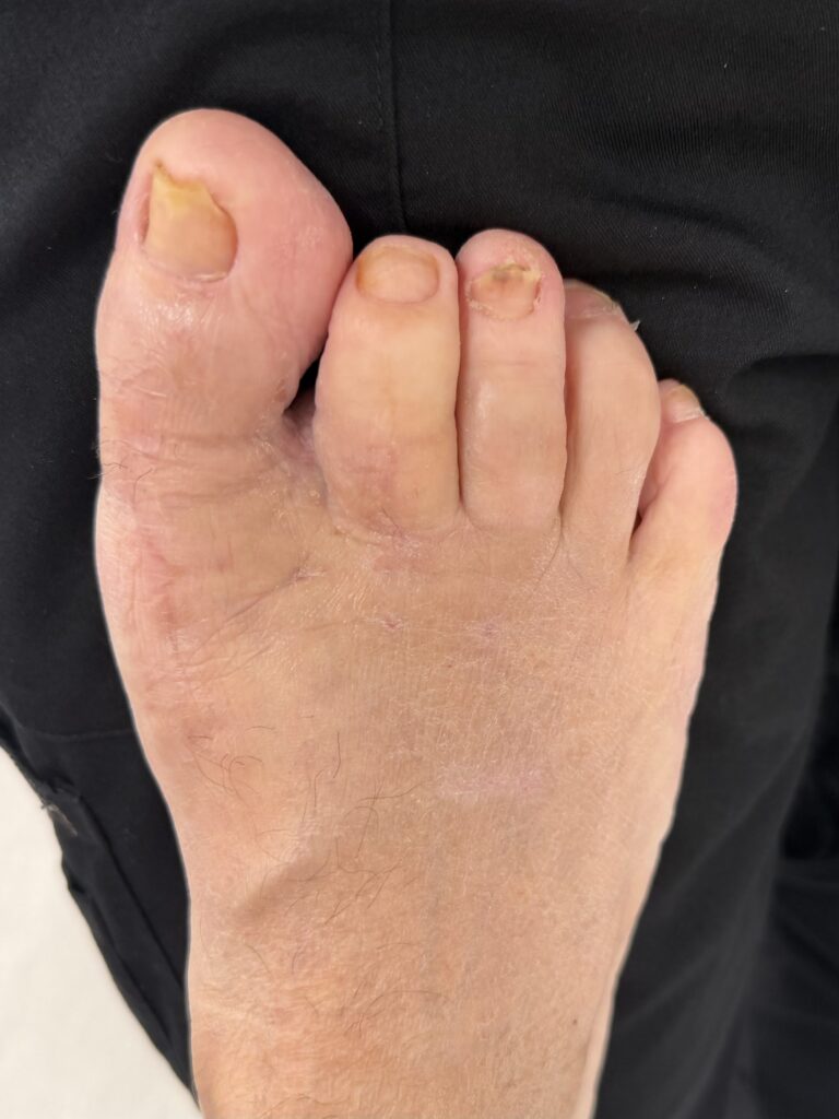 what to expect 3 weeks after bunion surgery