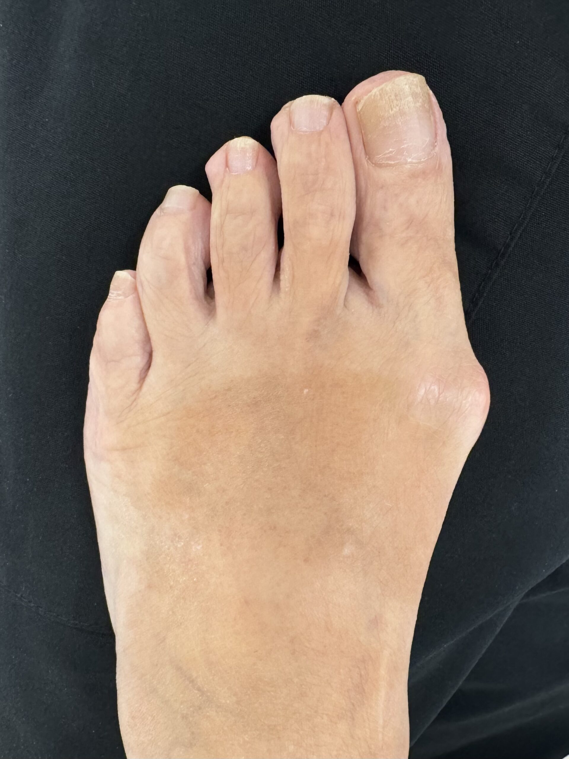 left foot with bunion