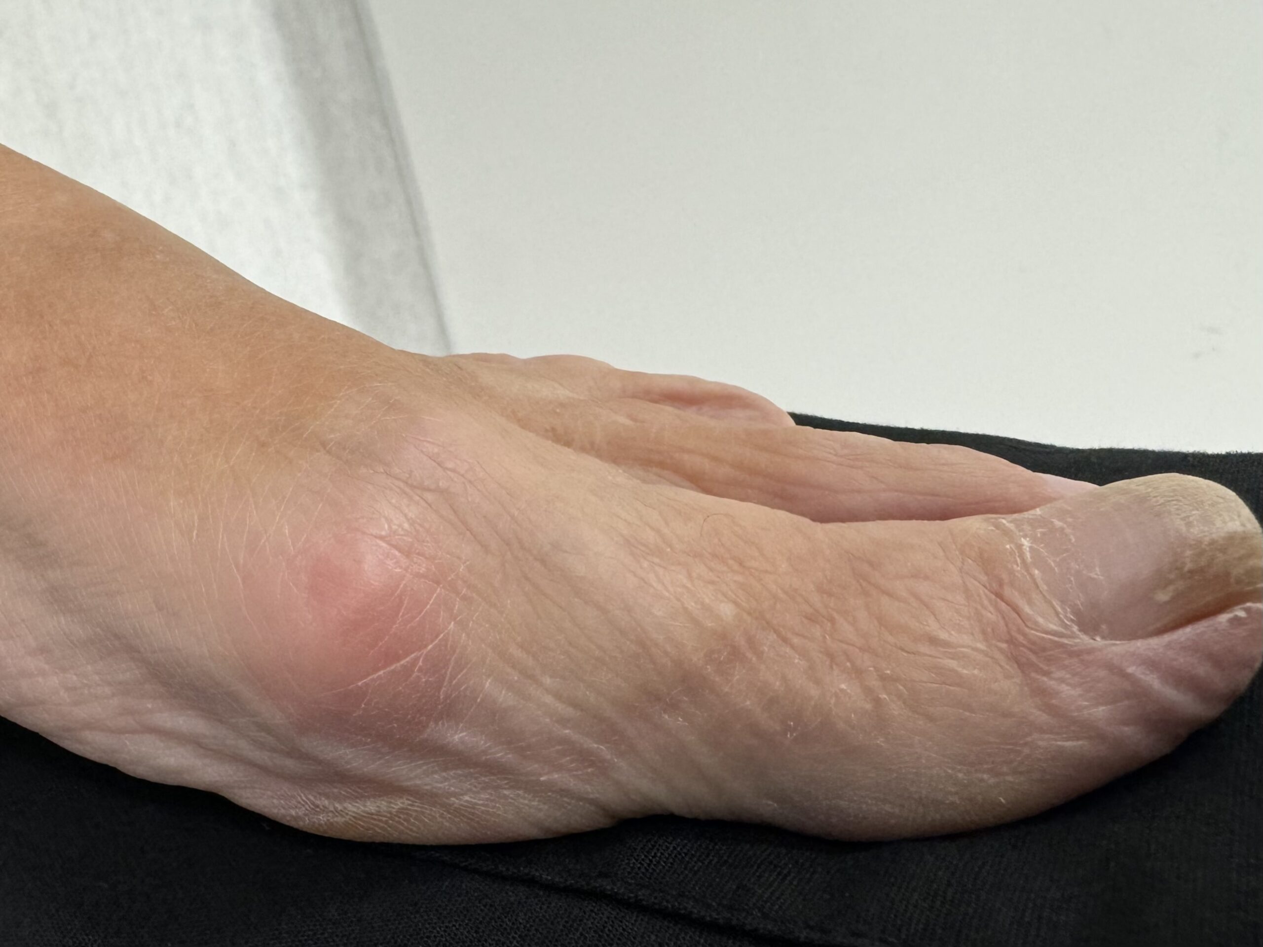foot with bunion pain