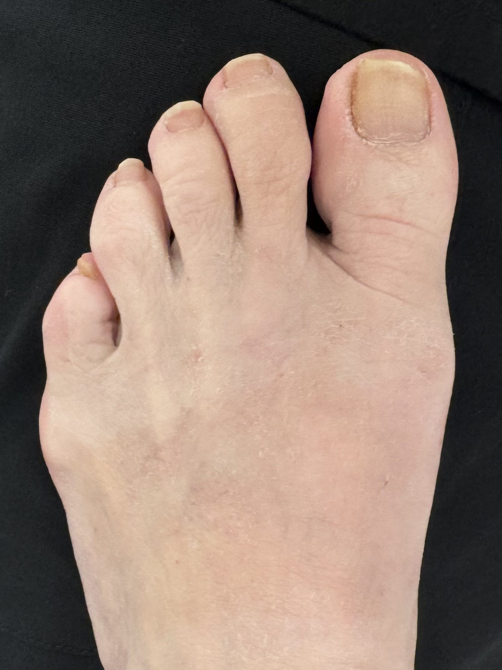 After Surgery