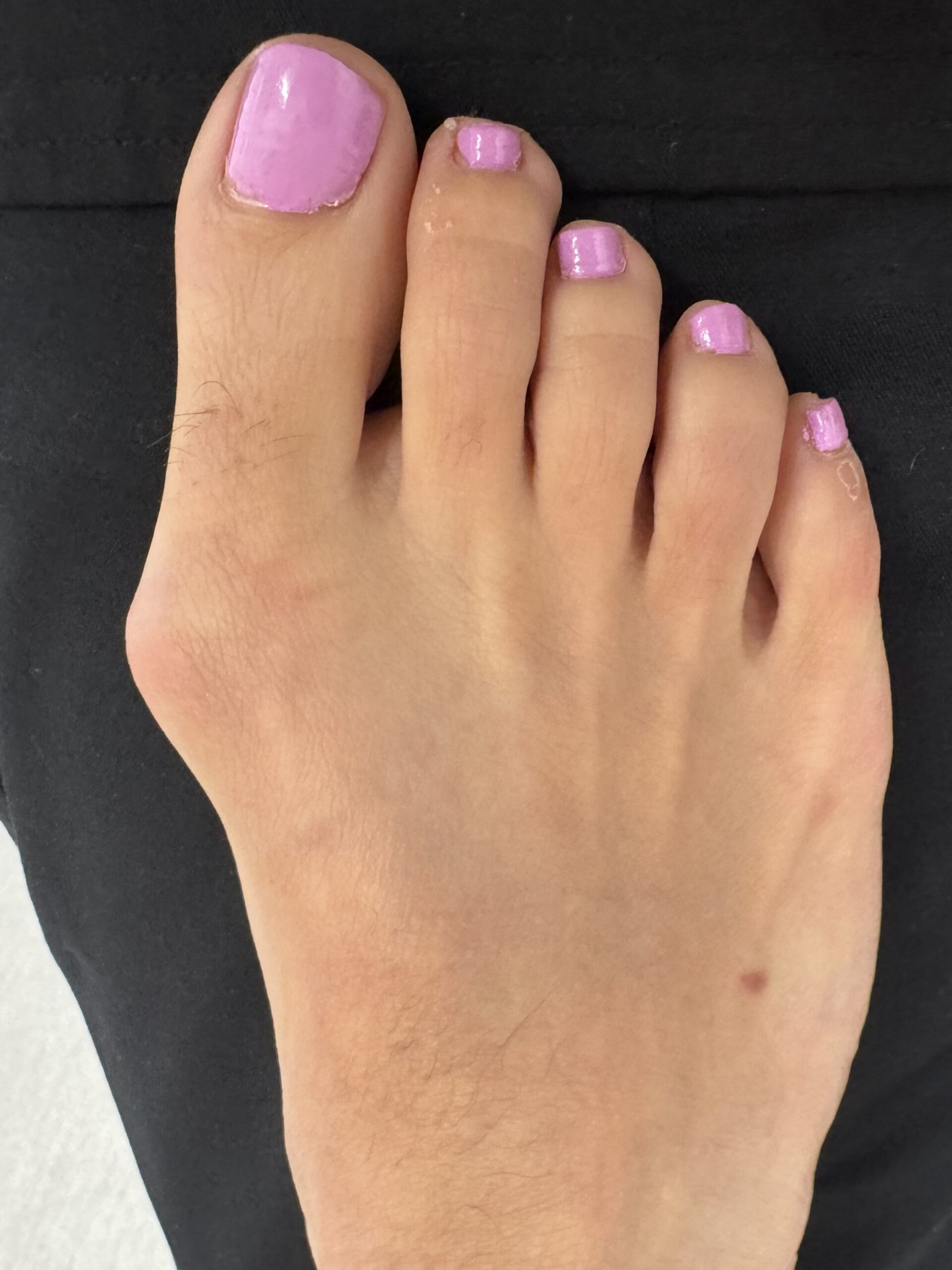 After Surgery