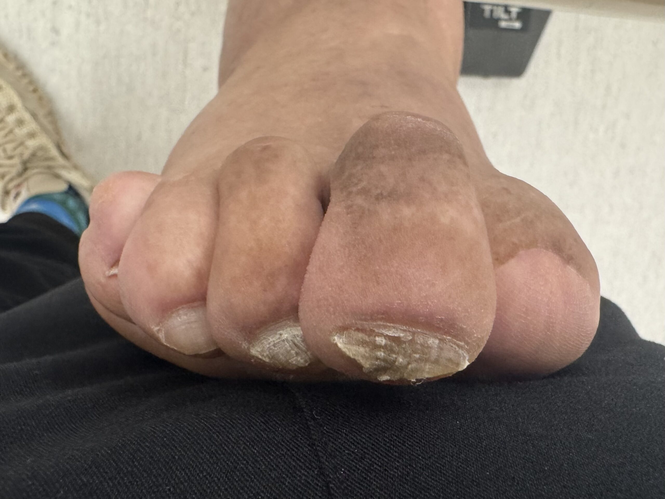 Mallet Toe before treatment — comparison 13