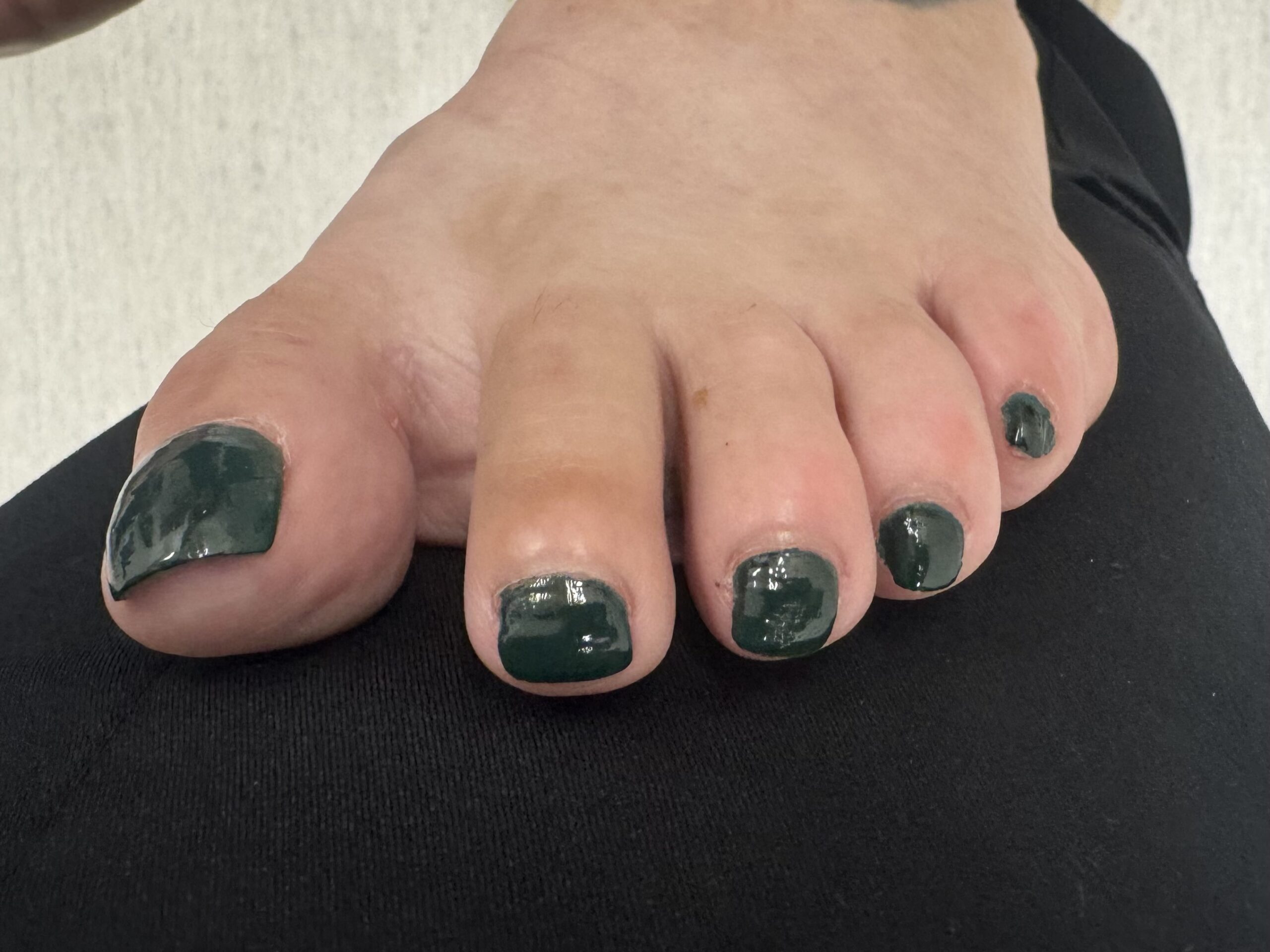 Extreme Bunion after treatment — comparison 15