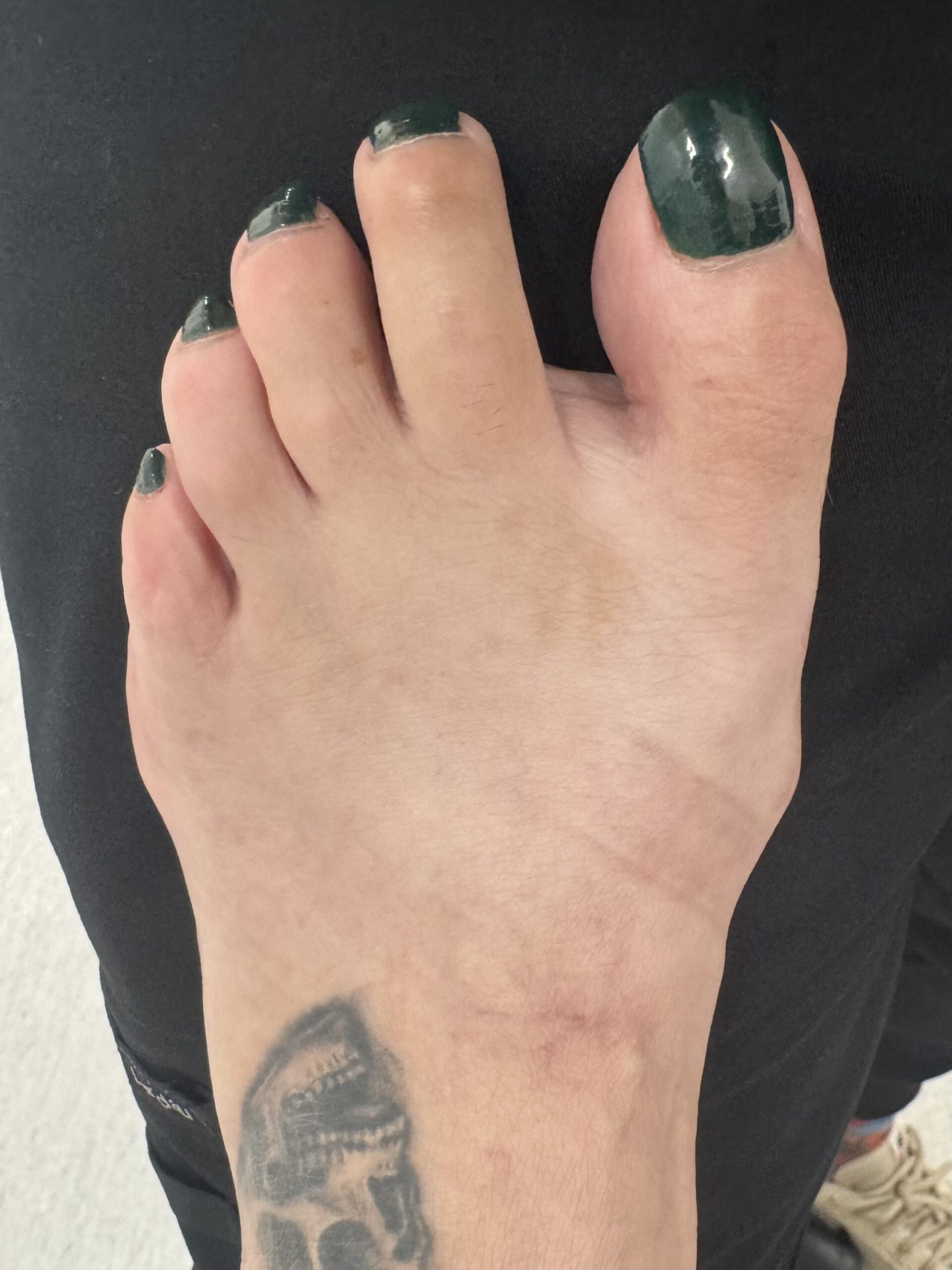 Extreme Bunion after treatment — comparison 13